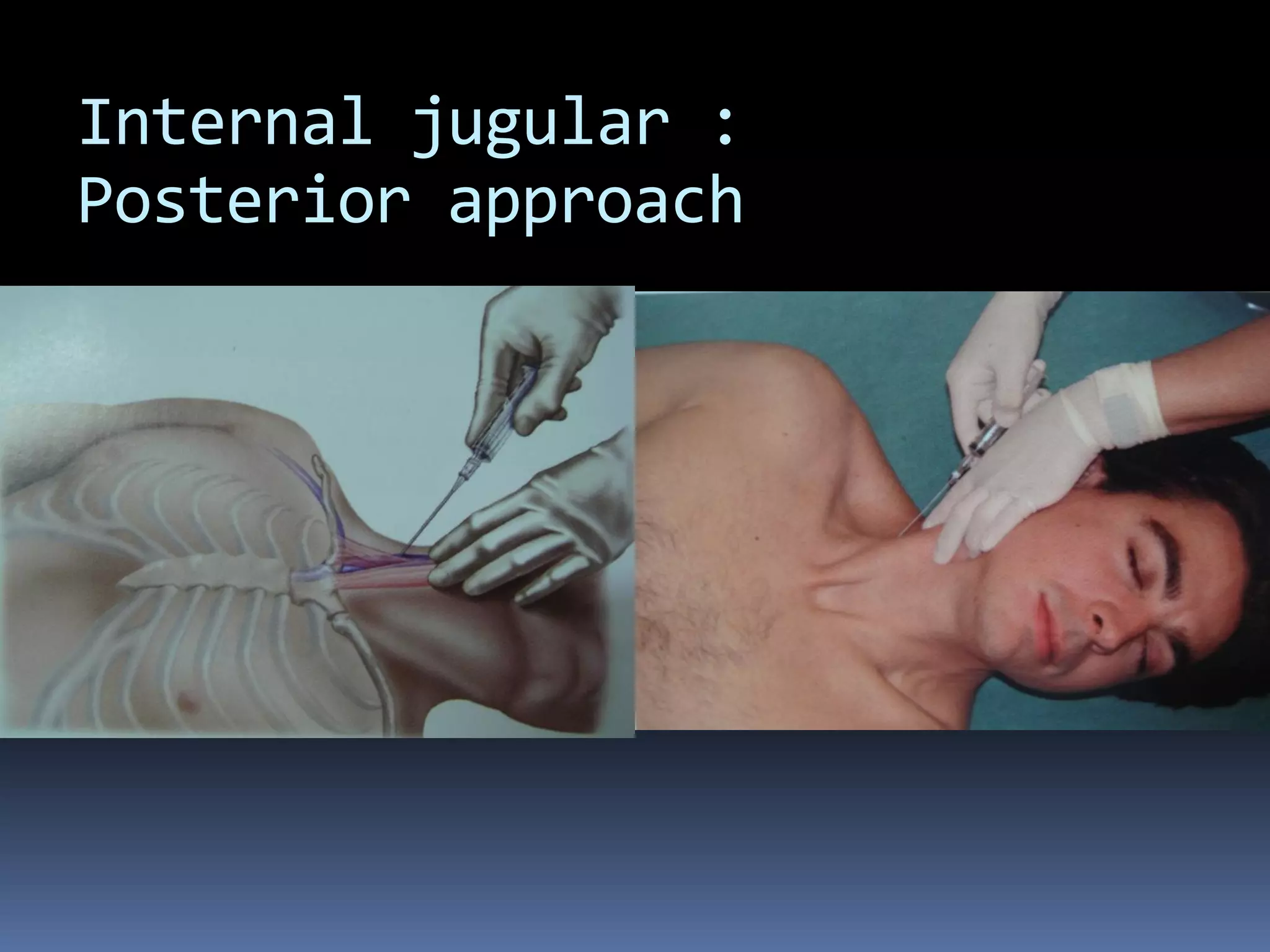 Internal jugular :
Posterior approach
 