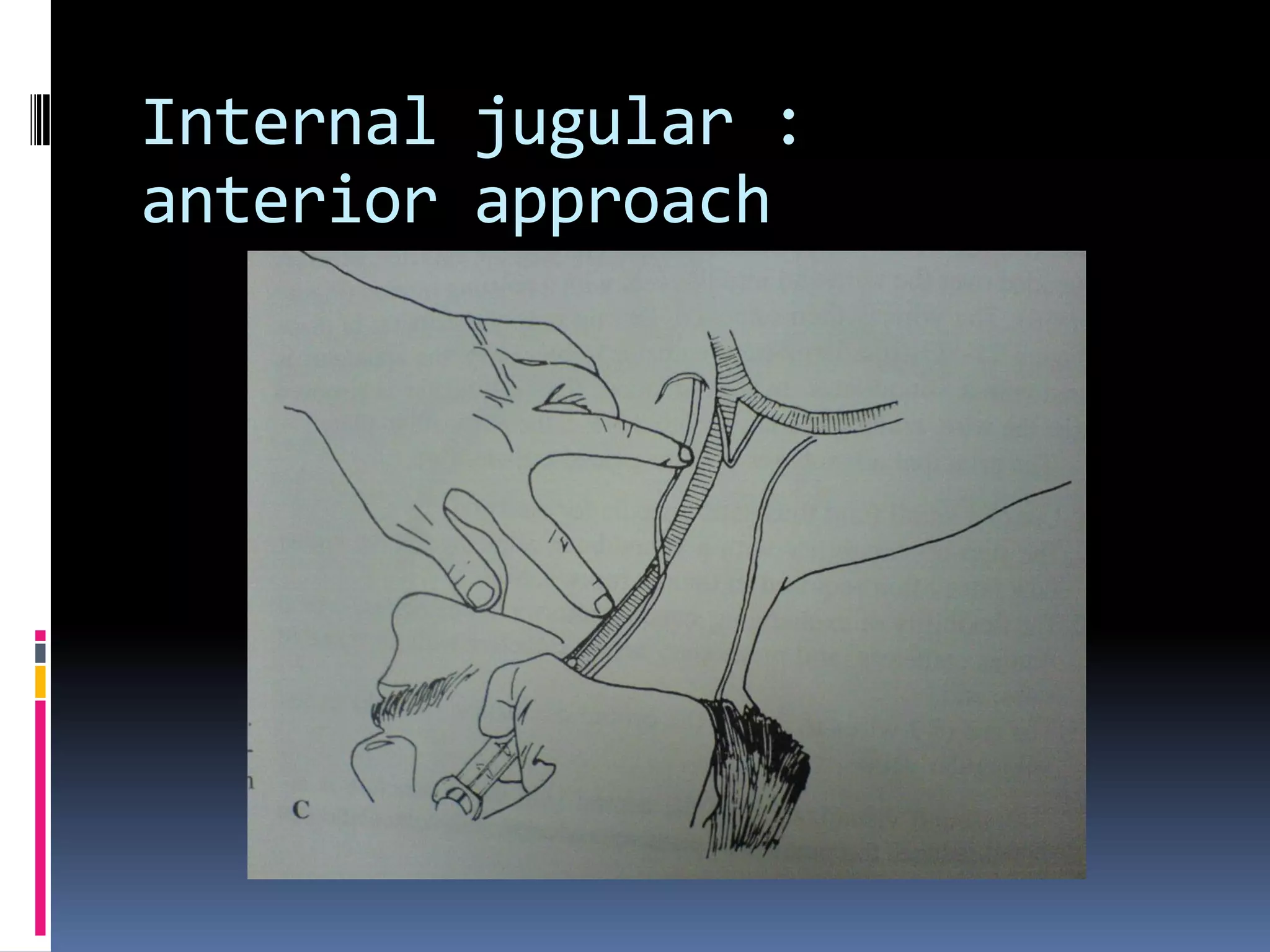 Internal jugular :
anterior approach
 