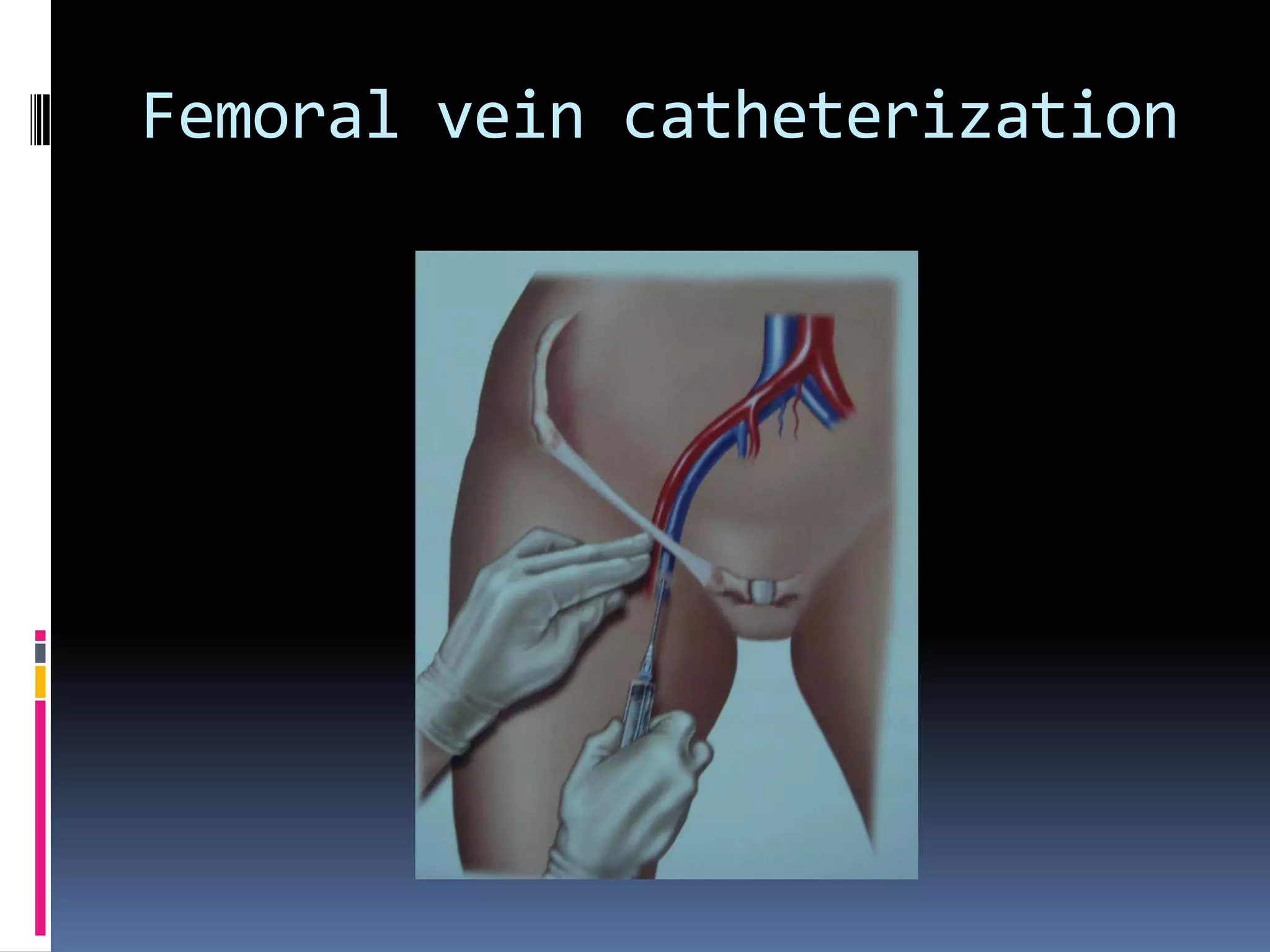 Femoral vein catheterization
 