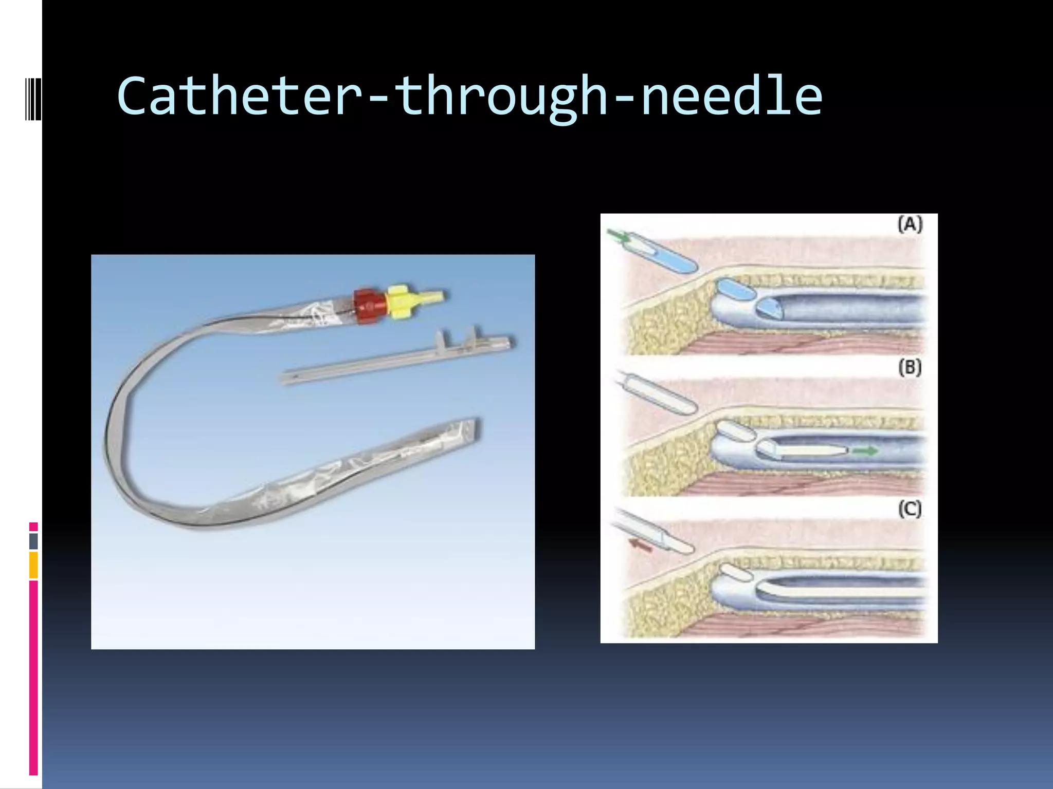 Catheter-through-needle
 