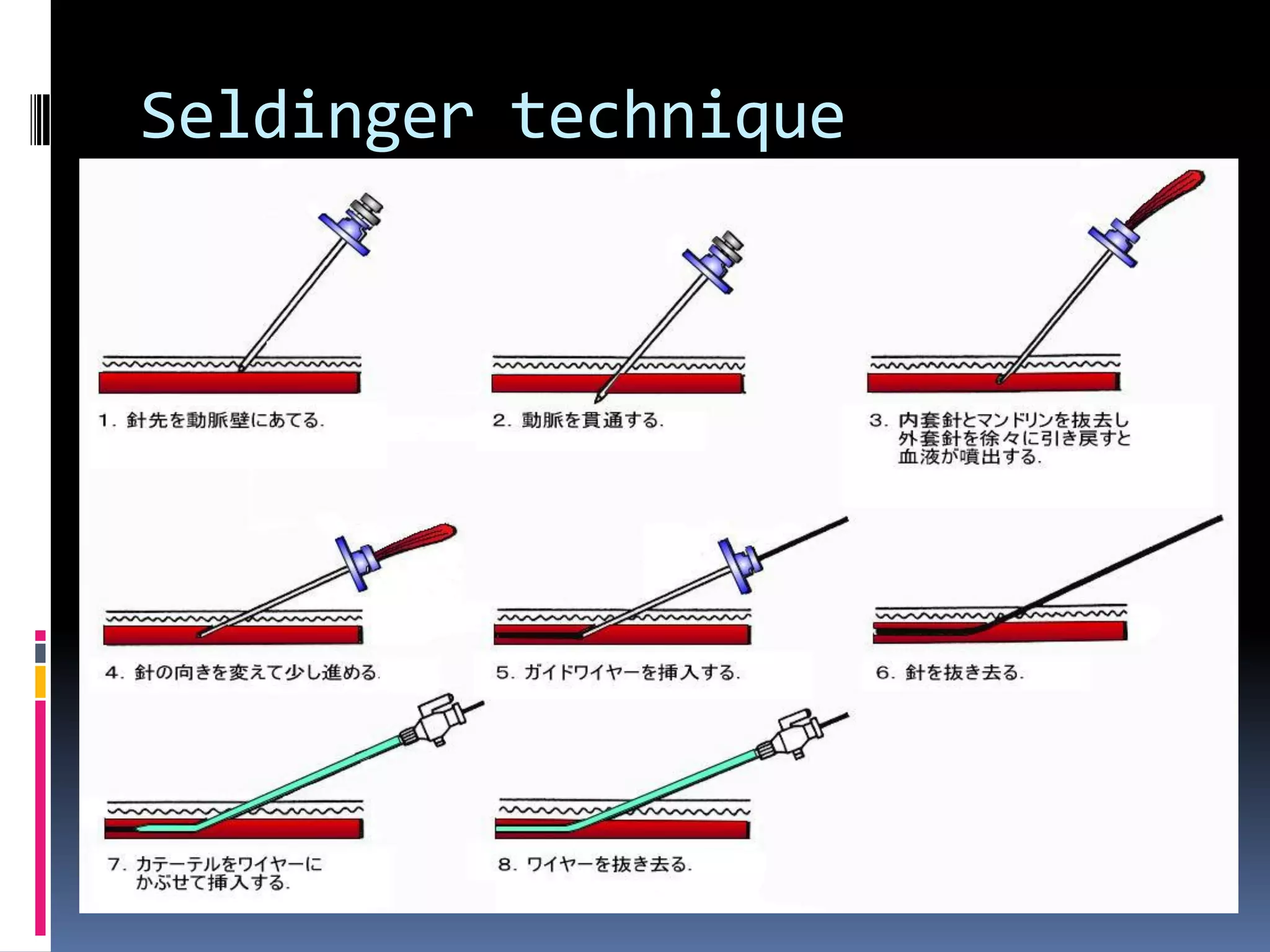 Seldinger technique
 