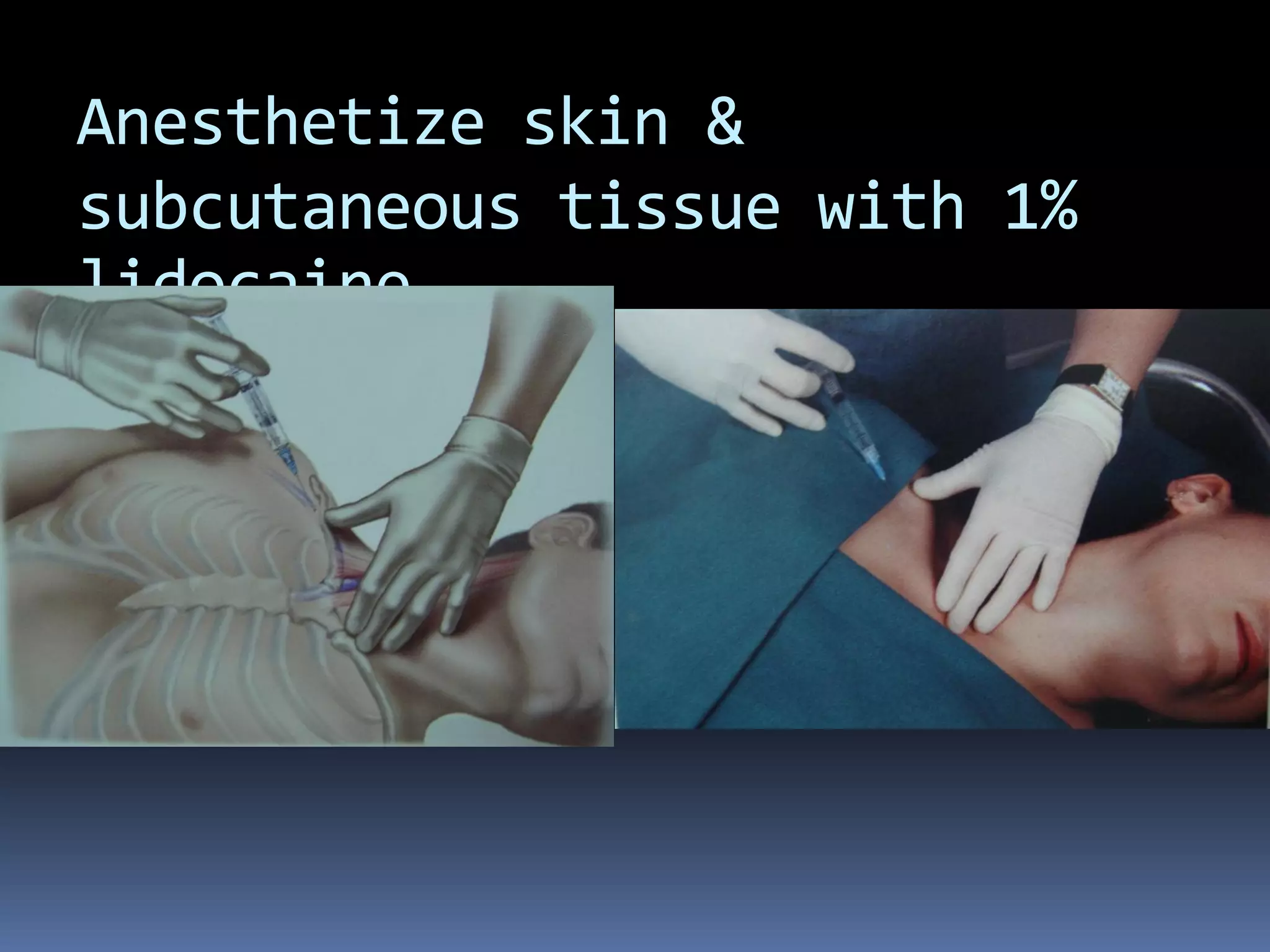 Anesthetize skin &
subcutaneous tissue with 1%
lidocaine.
 