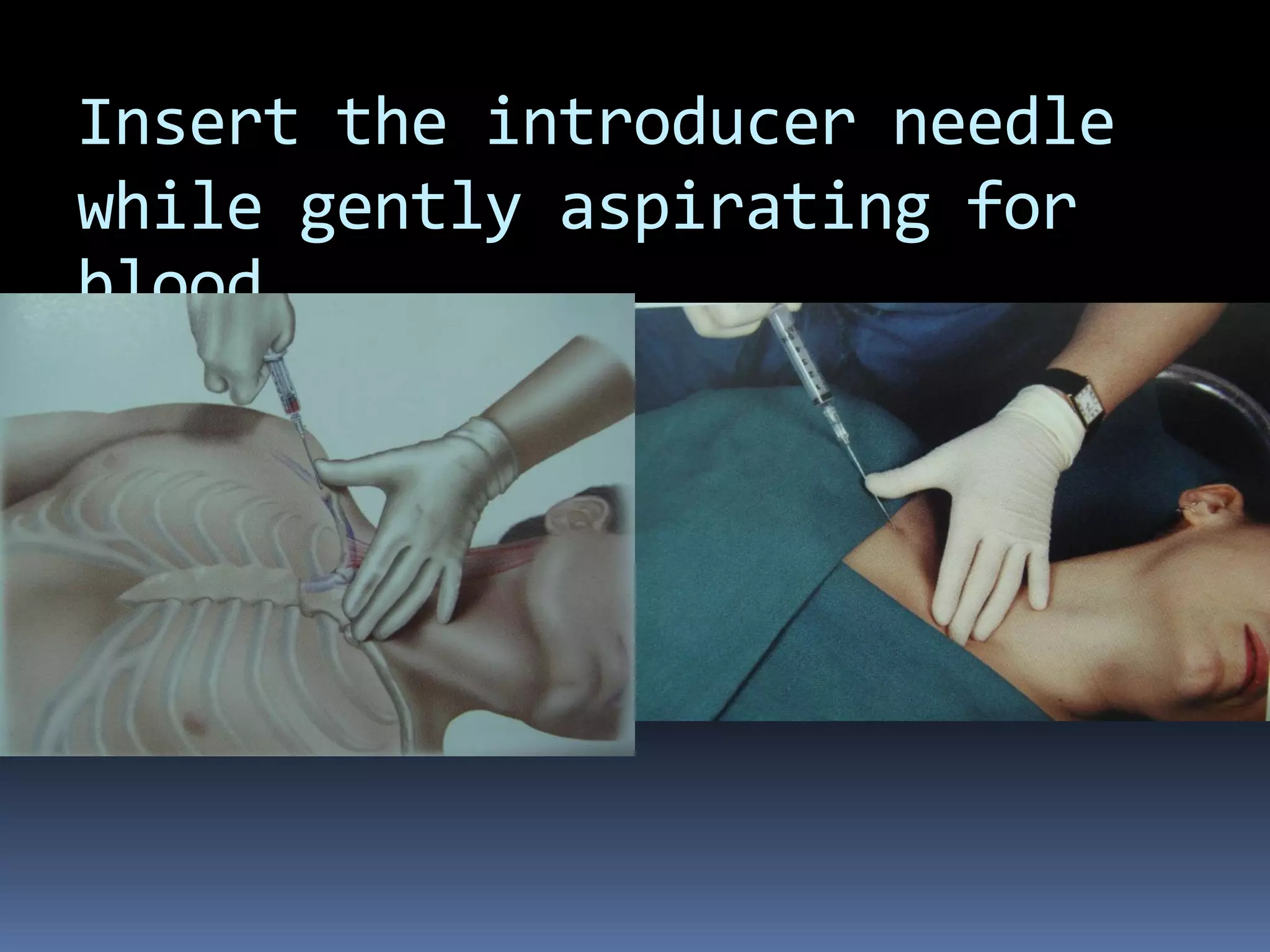 Insert the introducer needle
while gently aspirating for
blood.
 