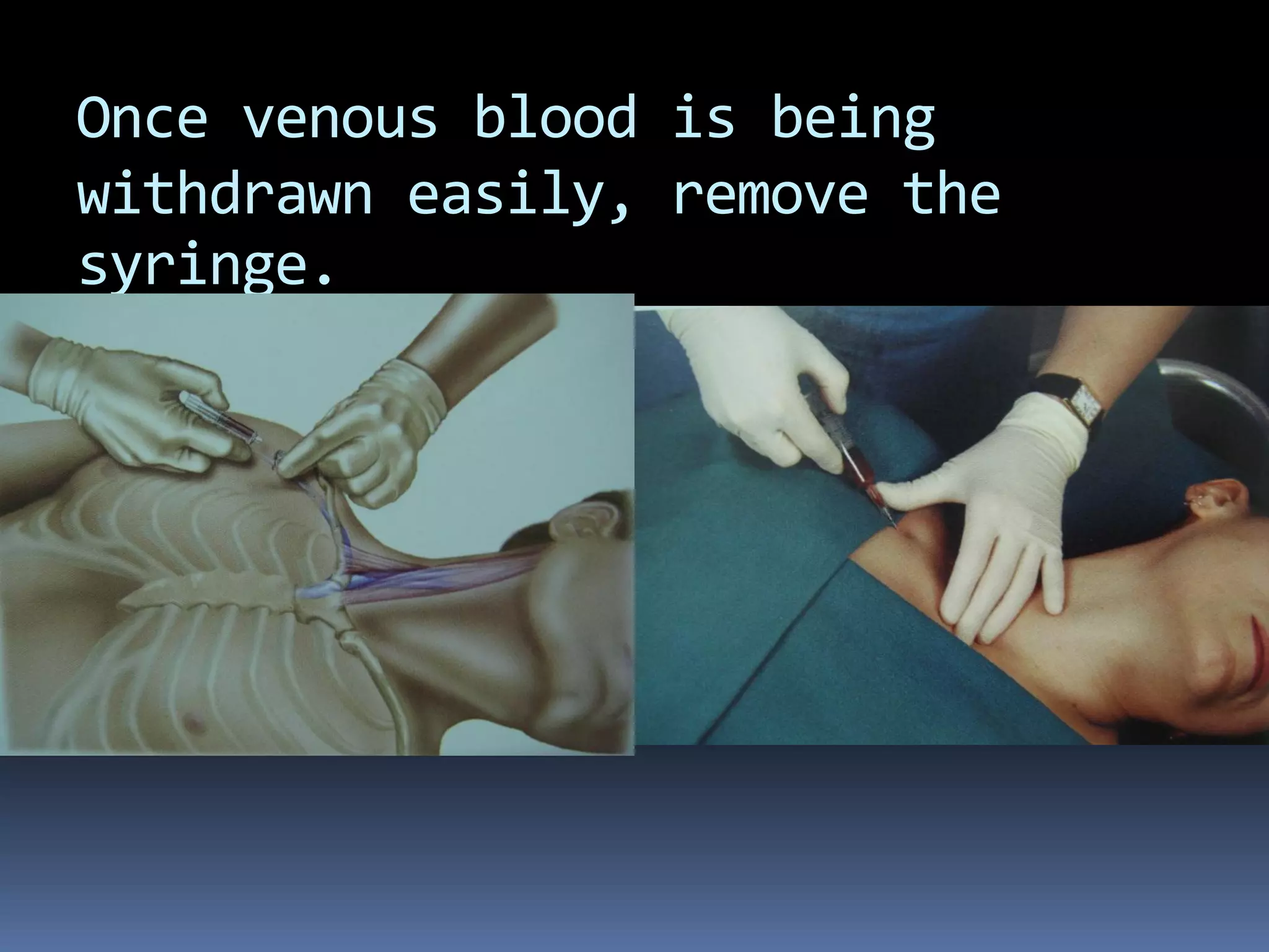 Once venous blood is being
withdrawn easily, remove the
syringe.
 