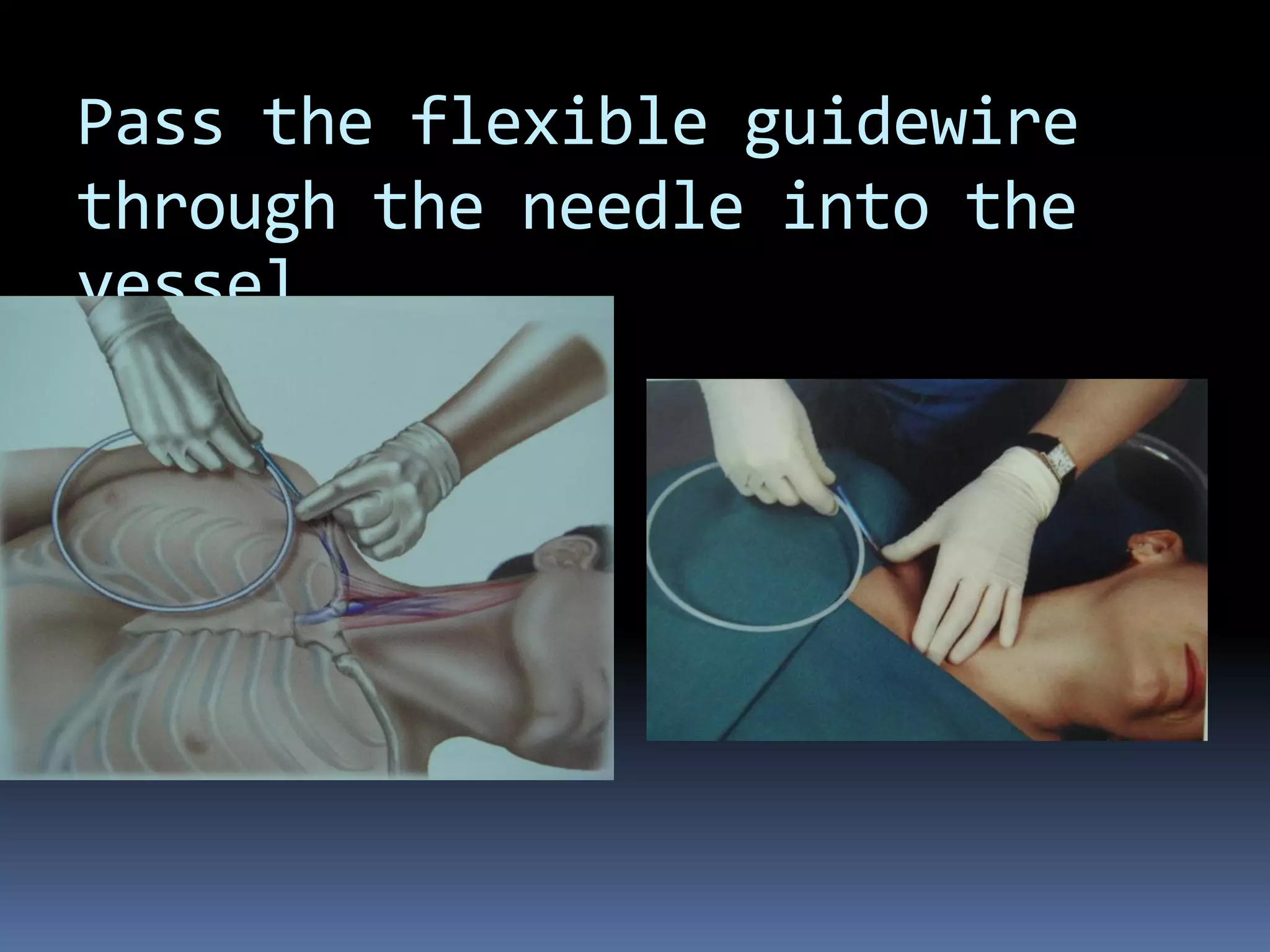 Pass the flexible guidewire
through the needle into the
vessel.
 