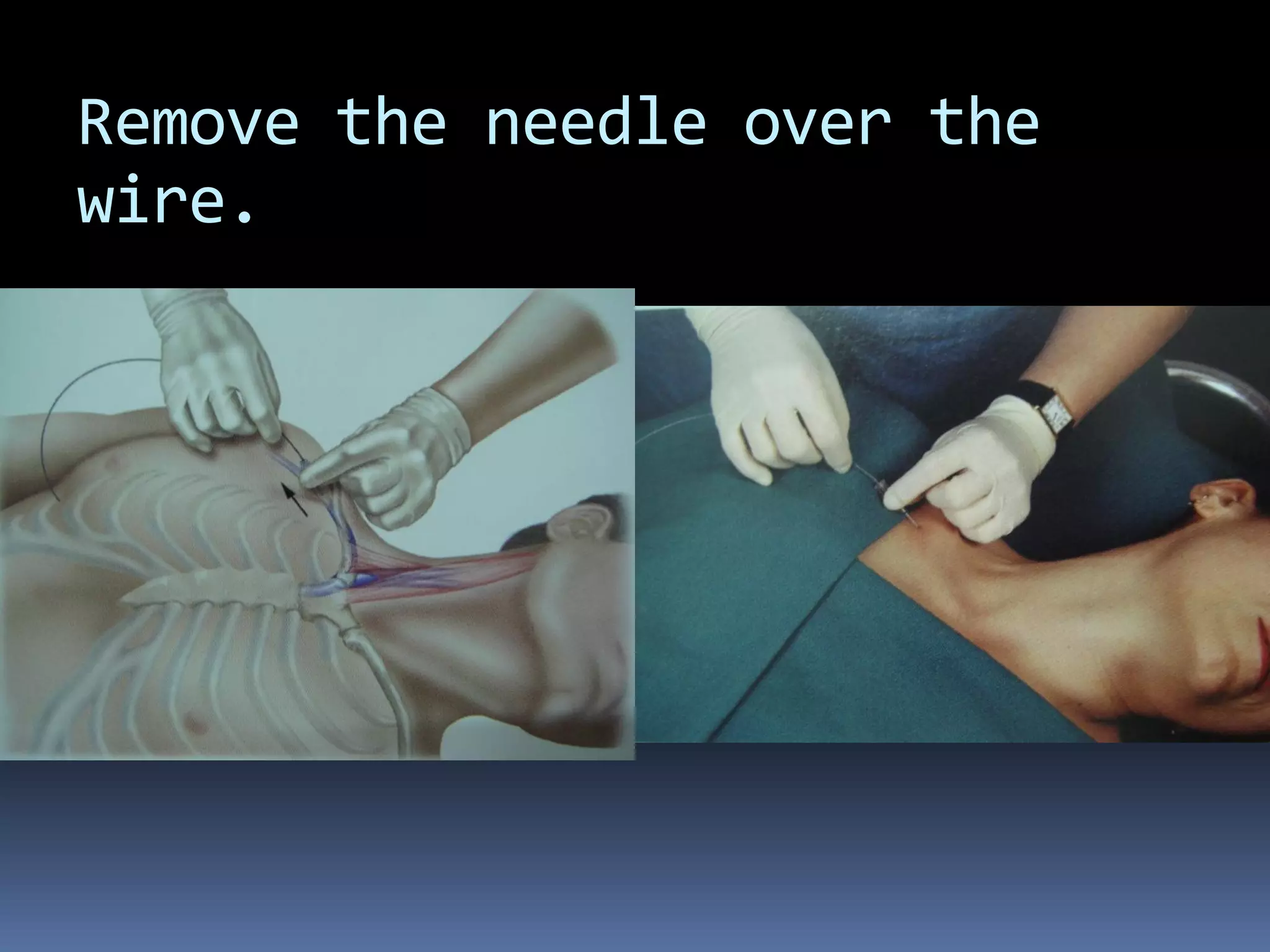 Remove the needle over the
wire.
 