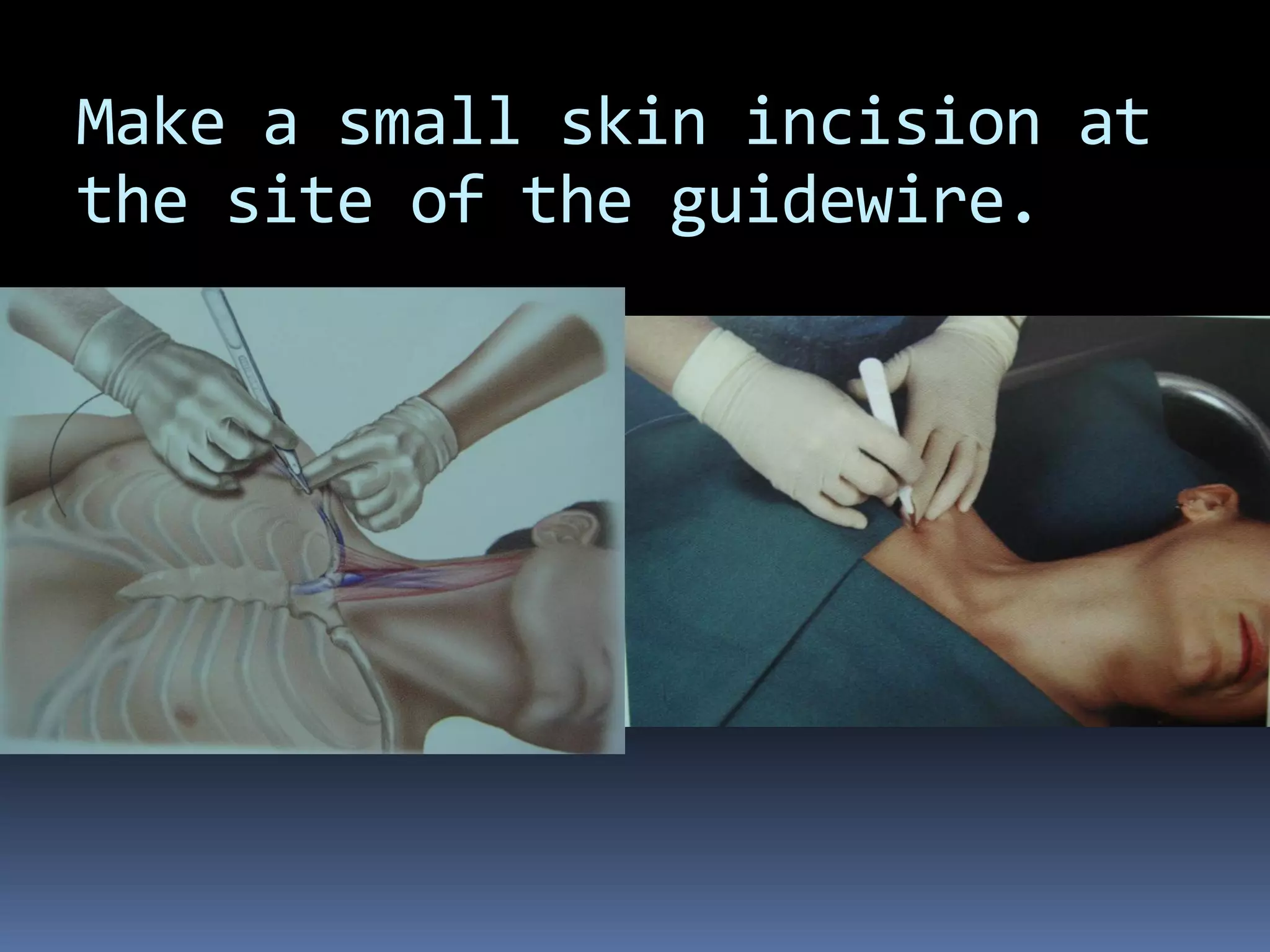 Make a small skin incision at
the site of the guidewire.
 