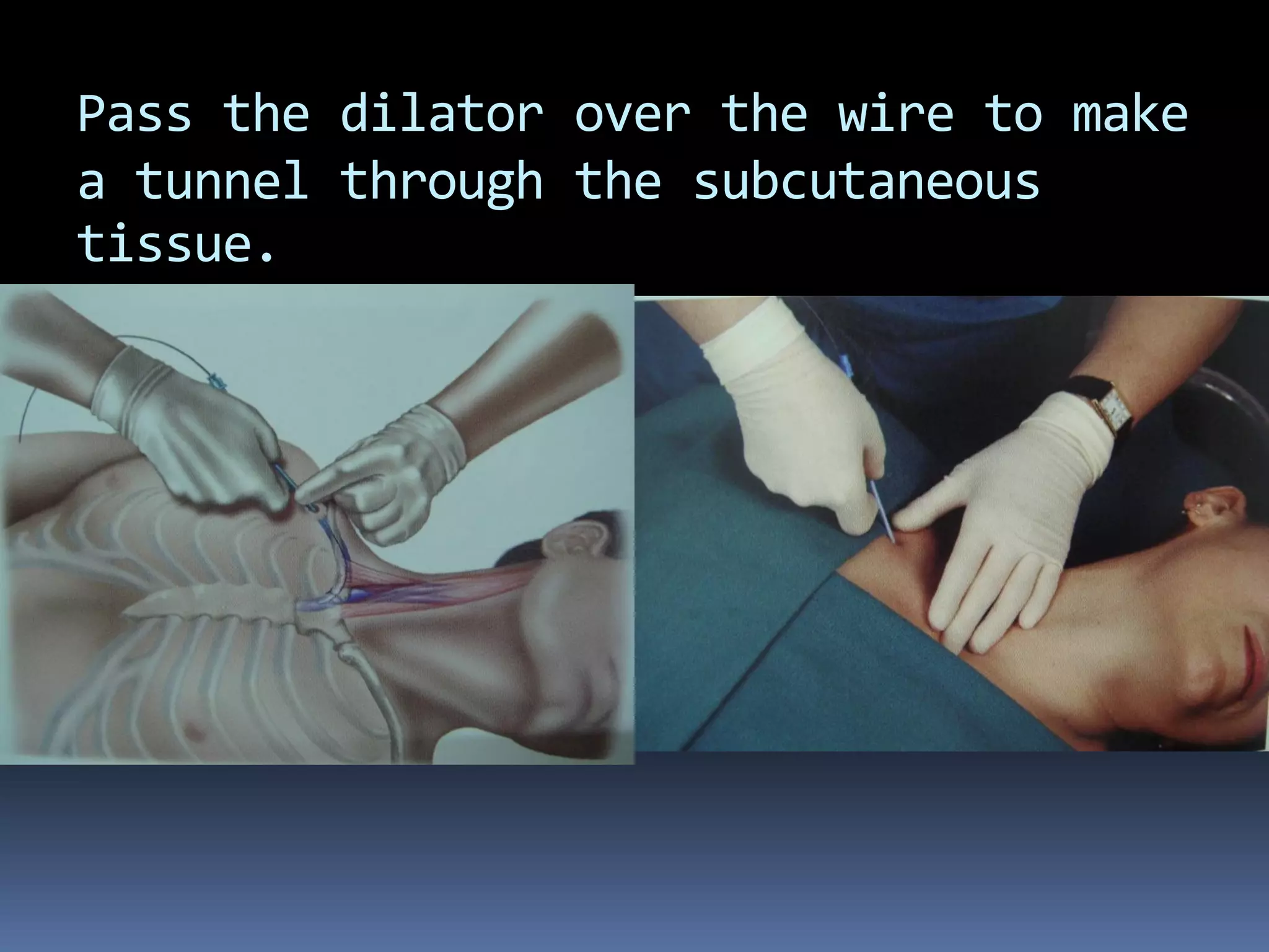 Pass the dilator over the wire to make
a tunnel through the subcutaneous
tissue.
 