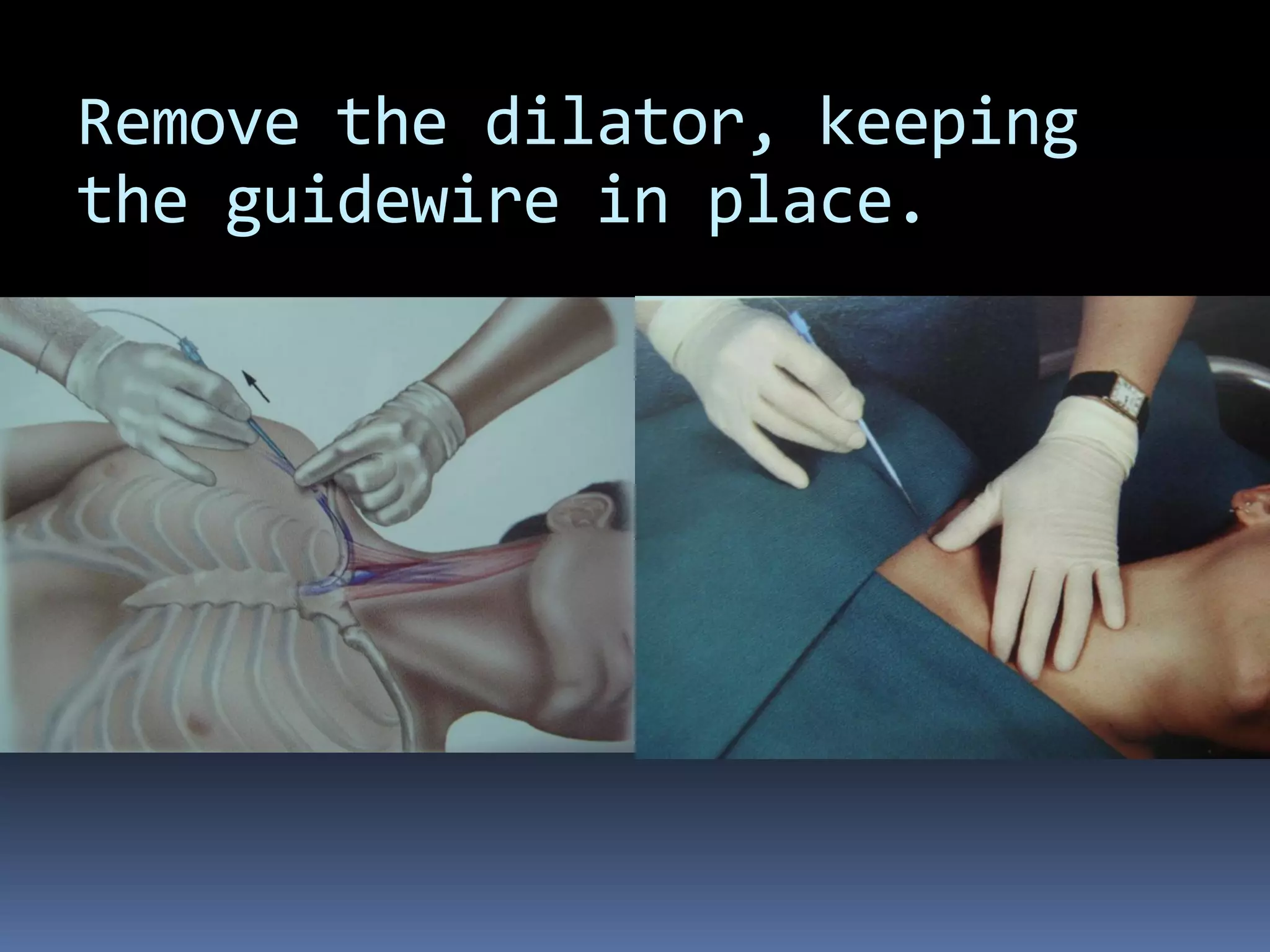 Remove the dilator, keeping
the guidewire in place.
 