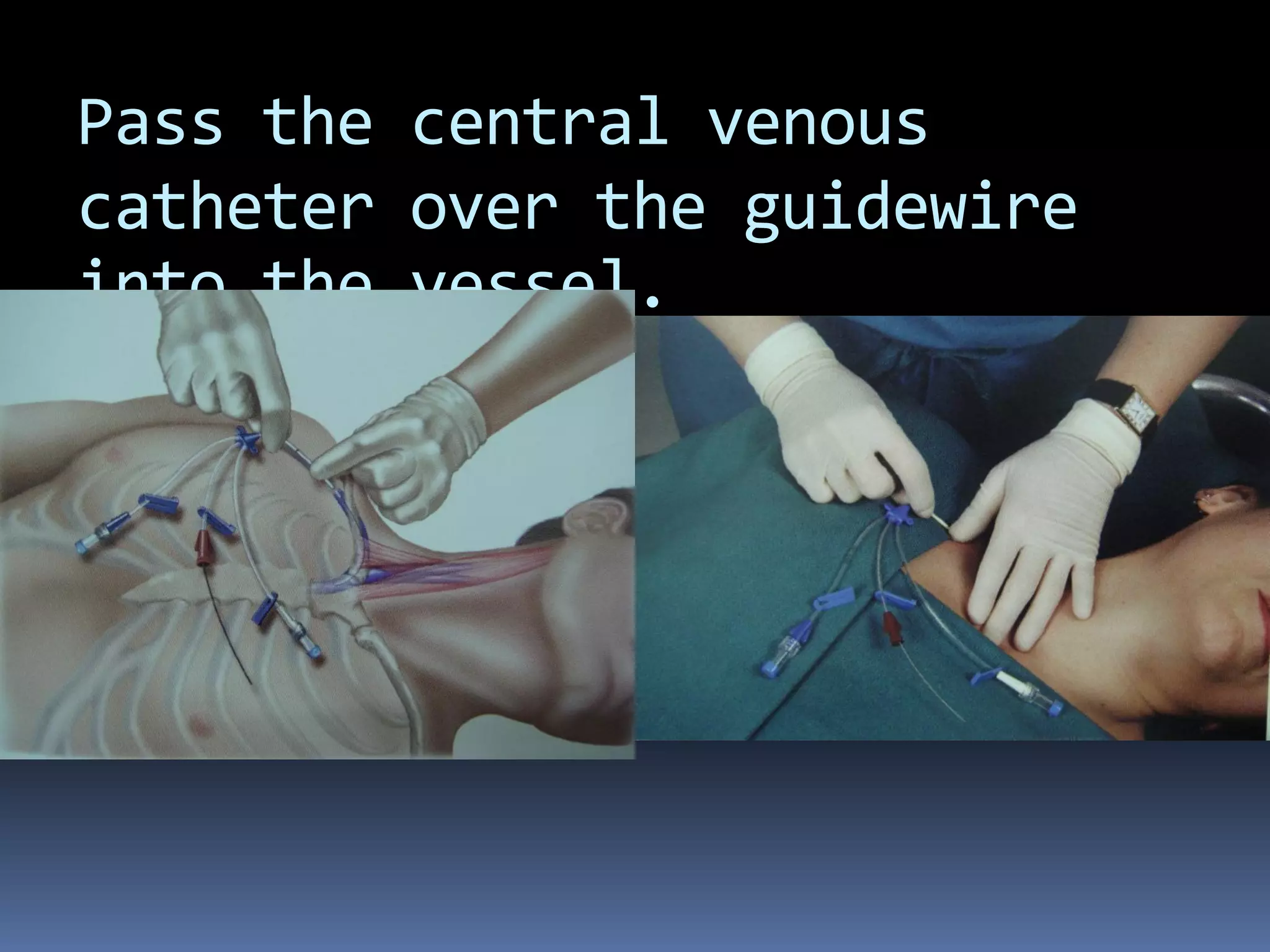 Pass the central venous
catheter over the guidewire
into the vessel.
 
