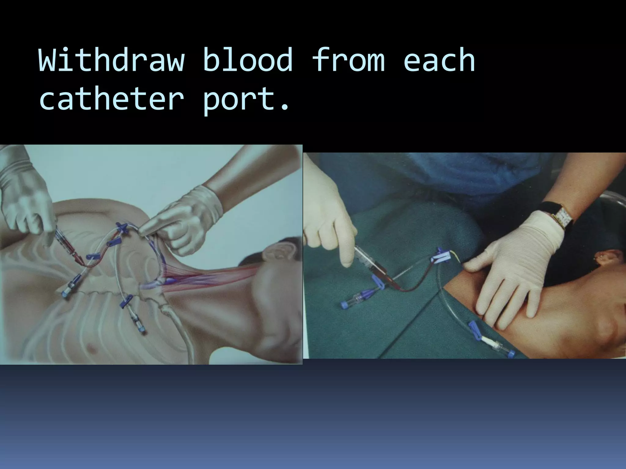 Withdraw blood from each
catheter port.
 