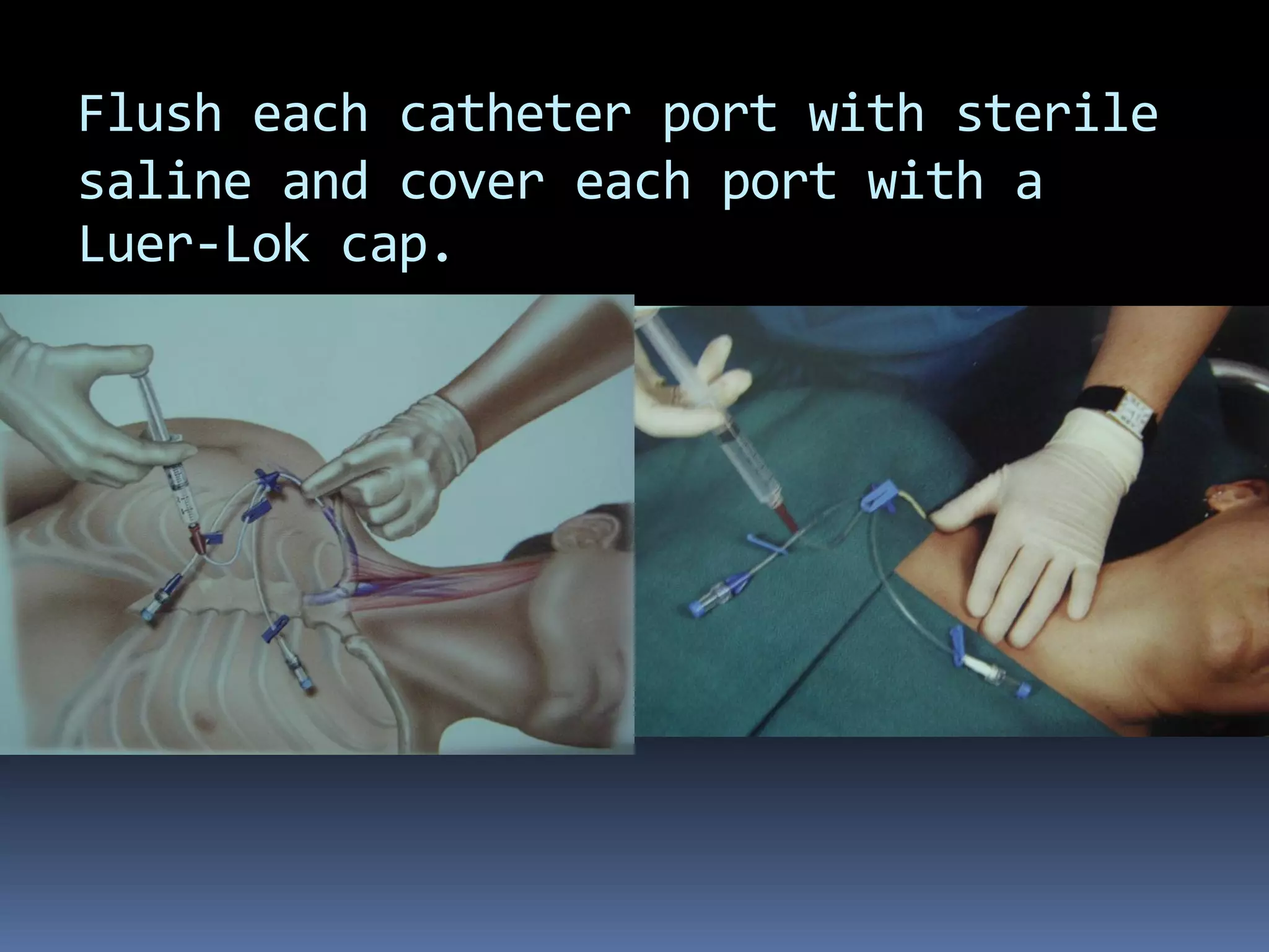 Flush each catheter port with sterile
saline and cover each port with a
Luer-Lok cap.
 