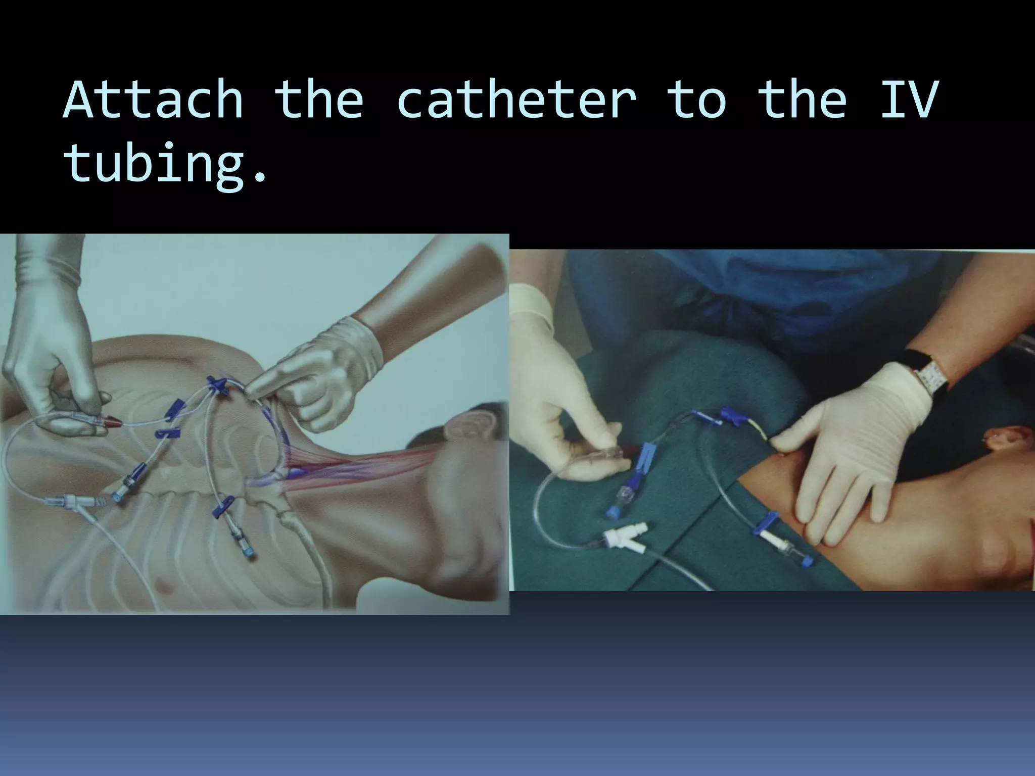 Attach the catheter to the IV
tubing.
 