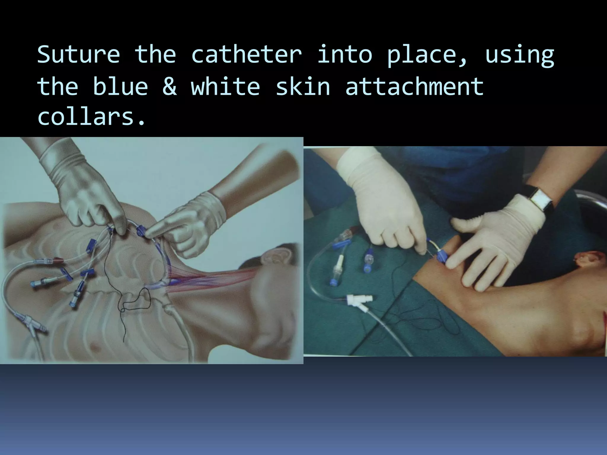 Suture the catheter into place, using
the blue & white skin attachment
collars.
 