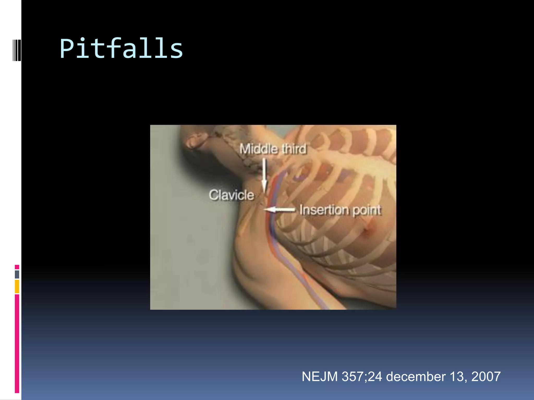 Pitfalls




           NEJM 357;24 december 13, 2007
 