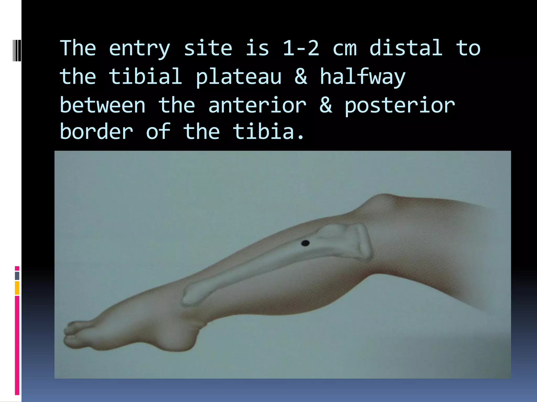 The entry site is 1-2 cm distal to
the tibial plateau & halfway
between the anterior & posterior
border of the tibia.
 