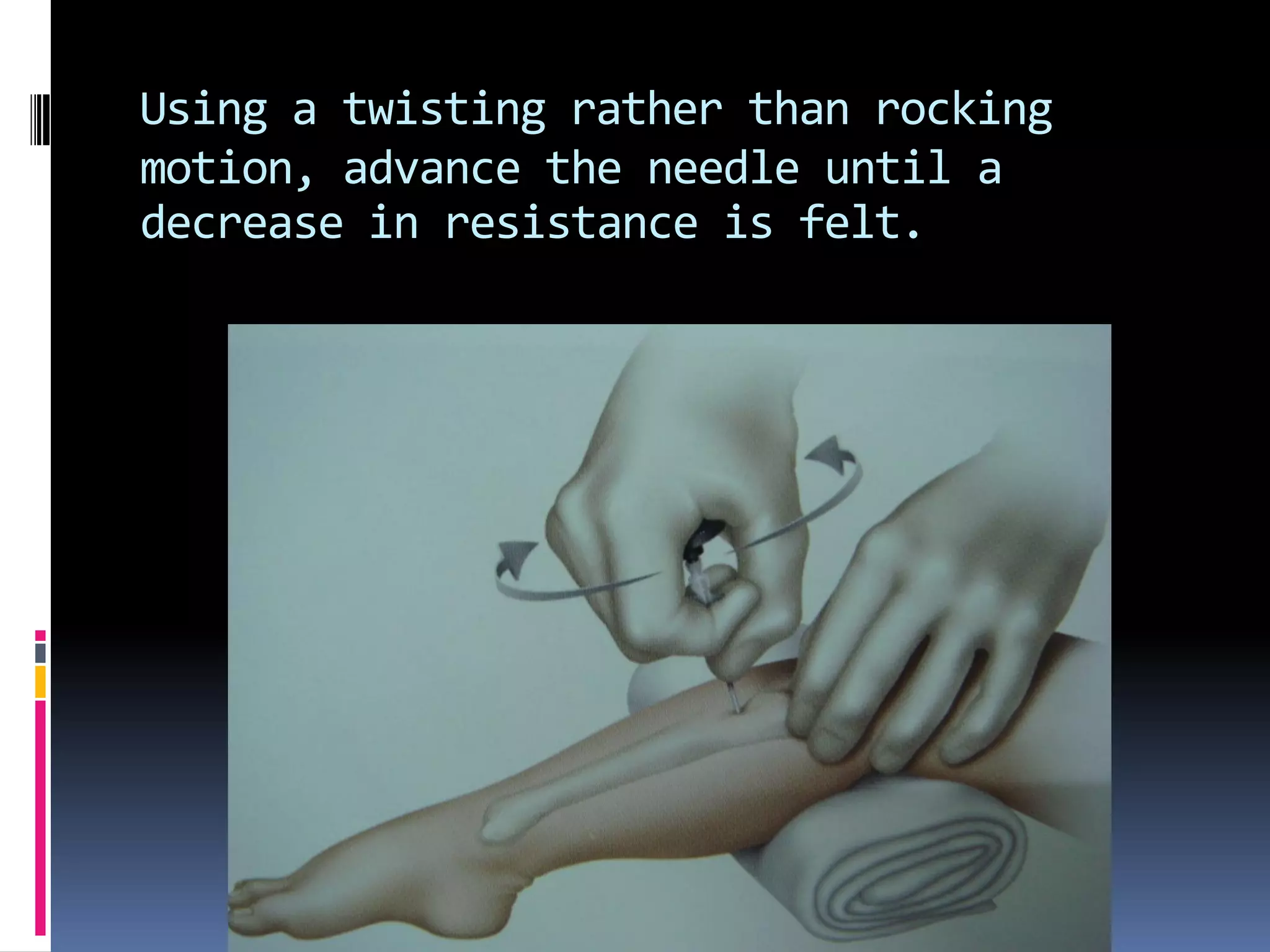 Using a twisting rather than rocking
motion, advance the needle until a
decrease in resistance is felt.
 