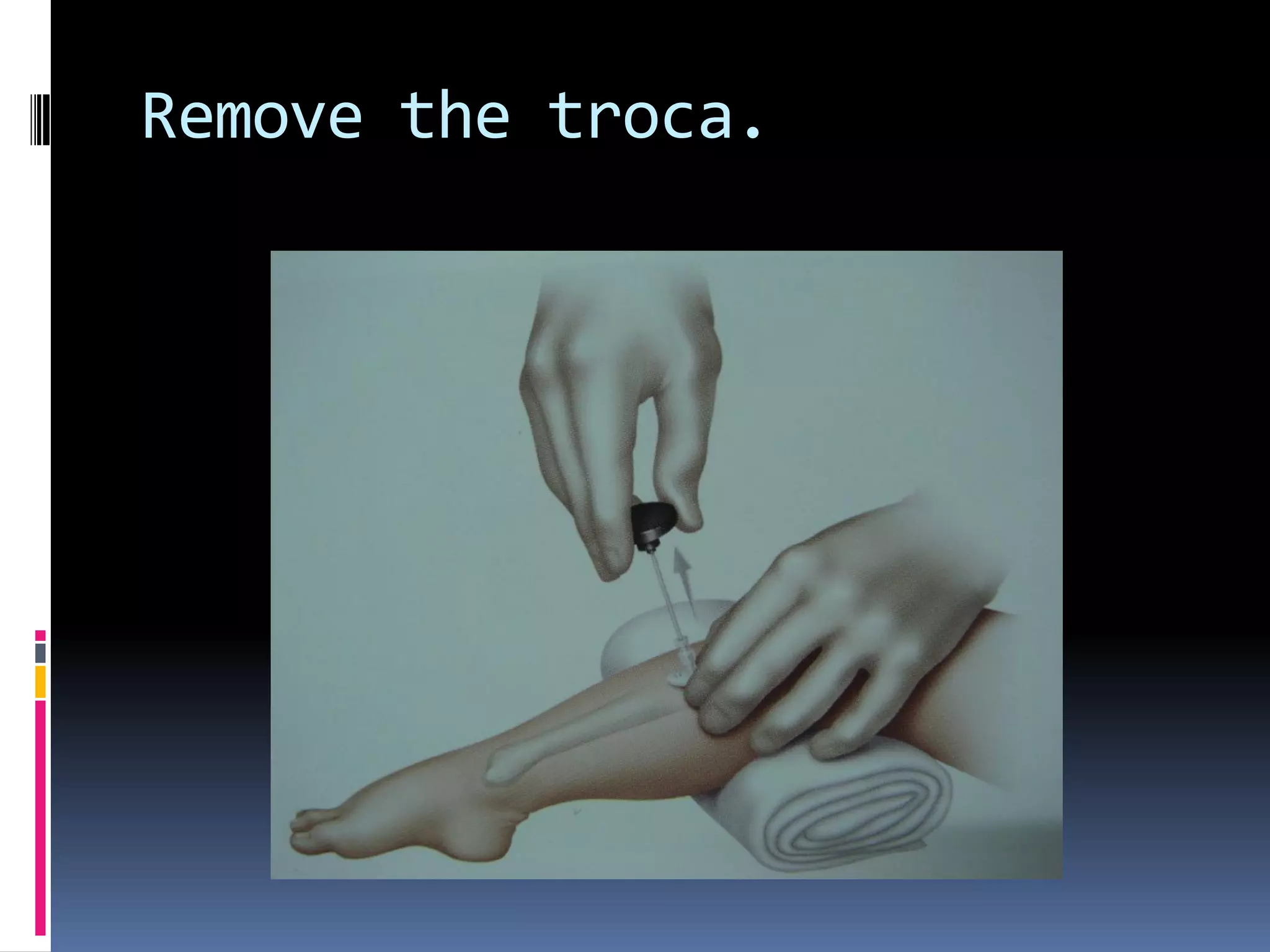 Remove the troca.
 