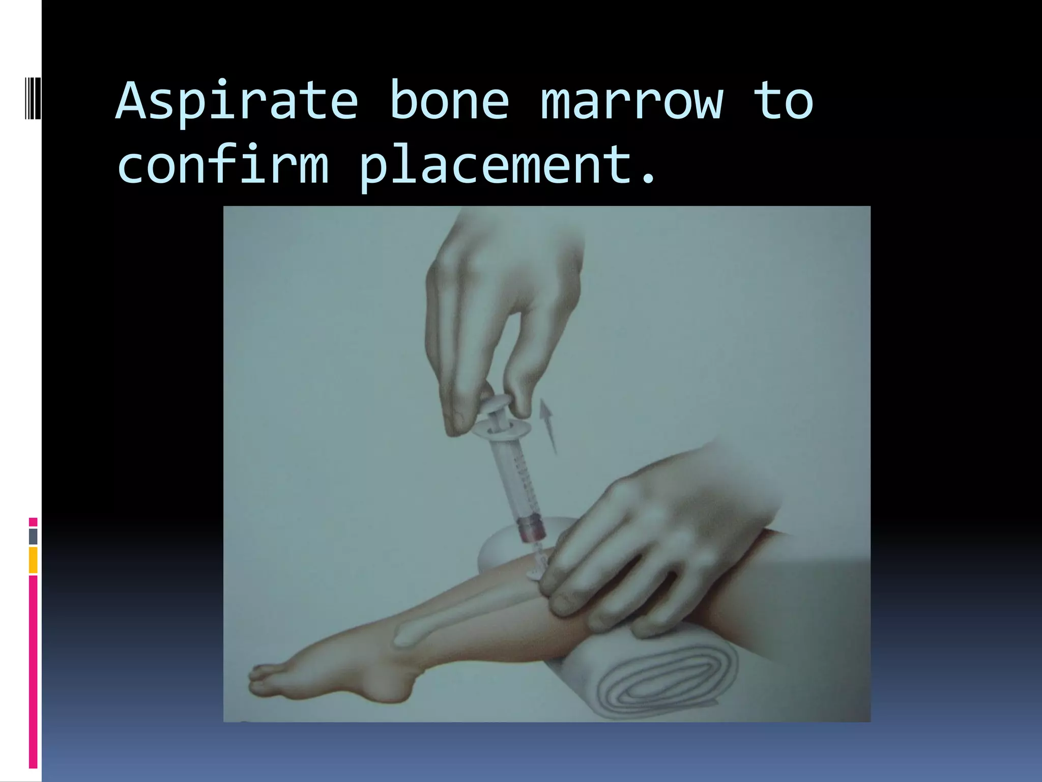 Aspirate bone marrow to
confirm placement.
 