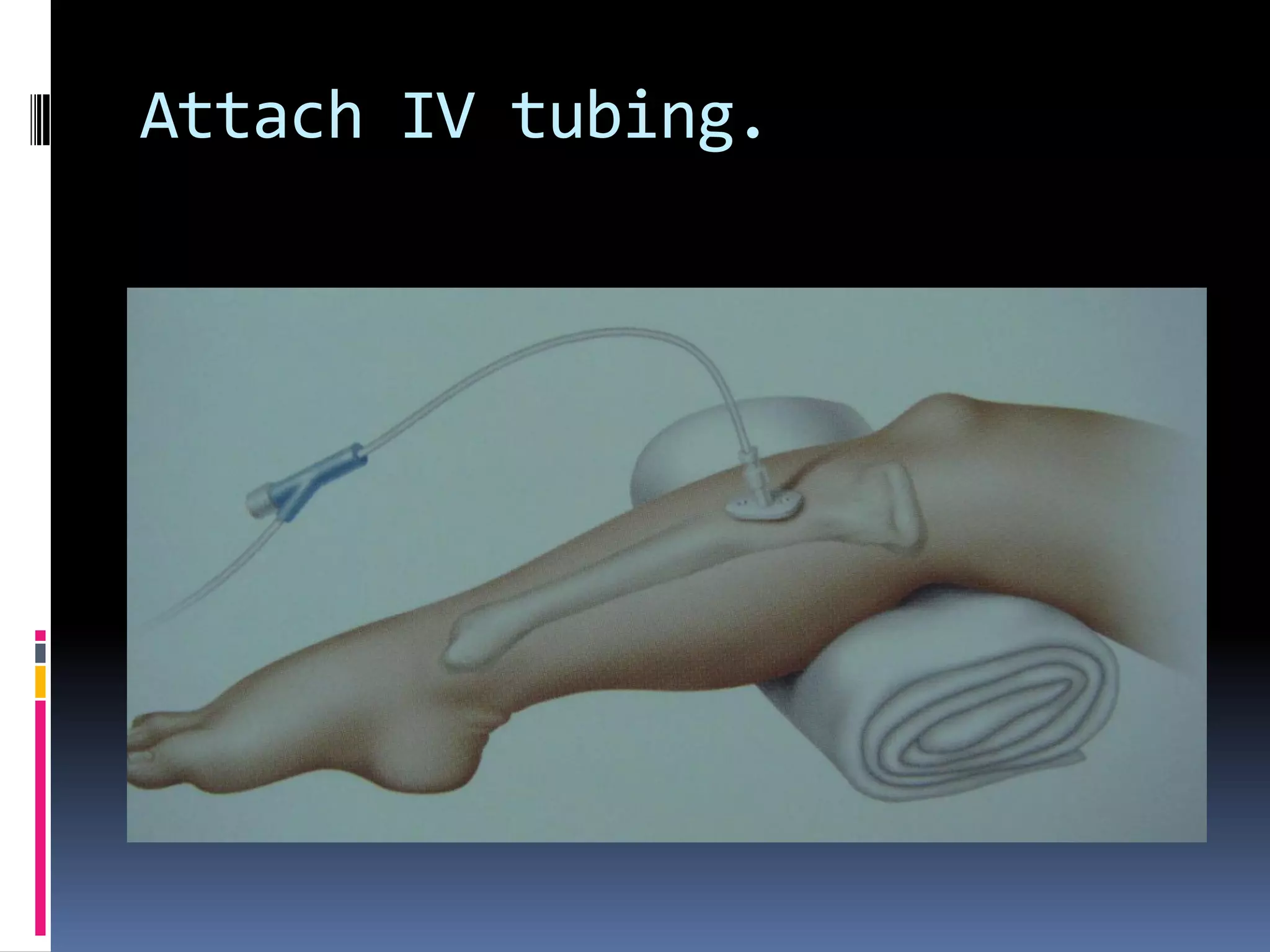 Attach IV tubing.
 