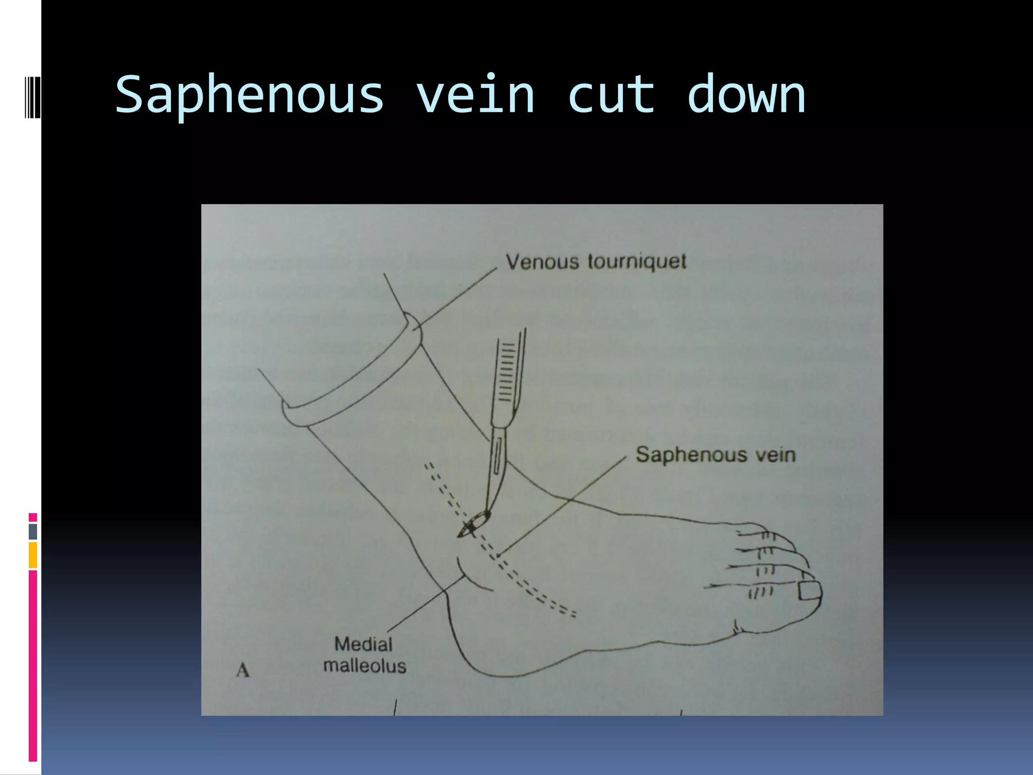 Saphenous vein cut down
 
