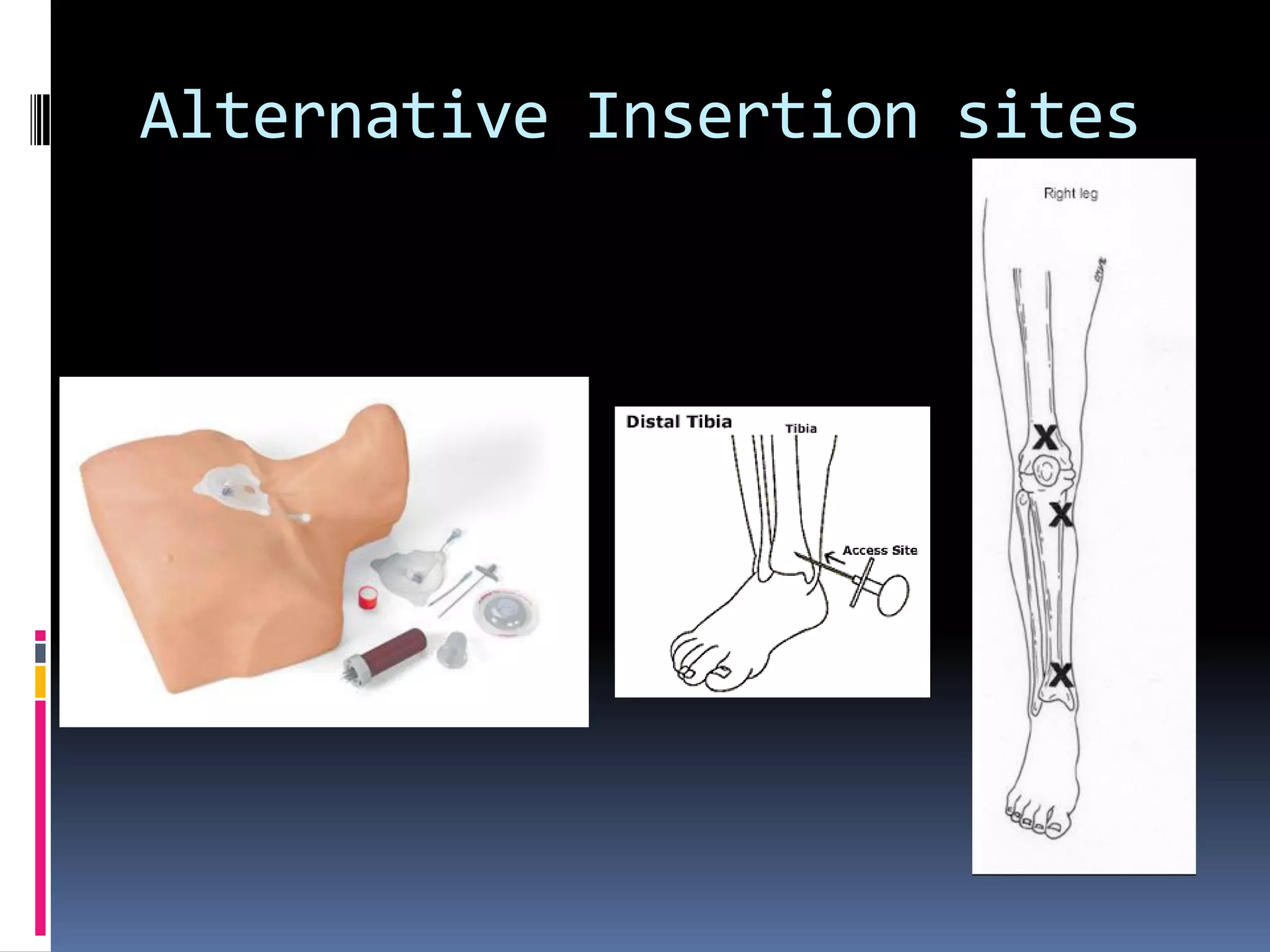 Alternative Insertion sites
 