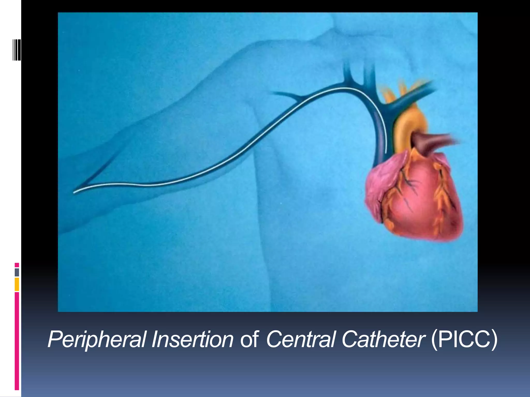 Peripheral Insertion of Central Catheter (PICC)
 