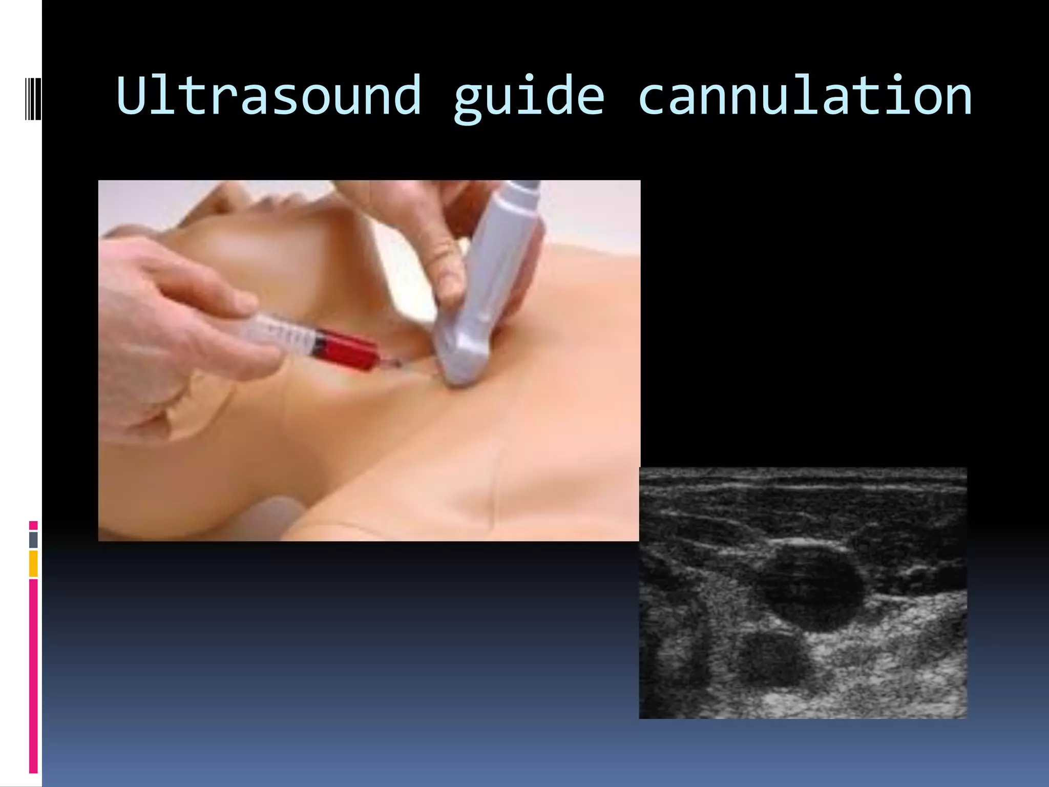 Ultrasound guide cannulation
 