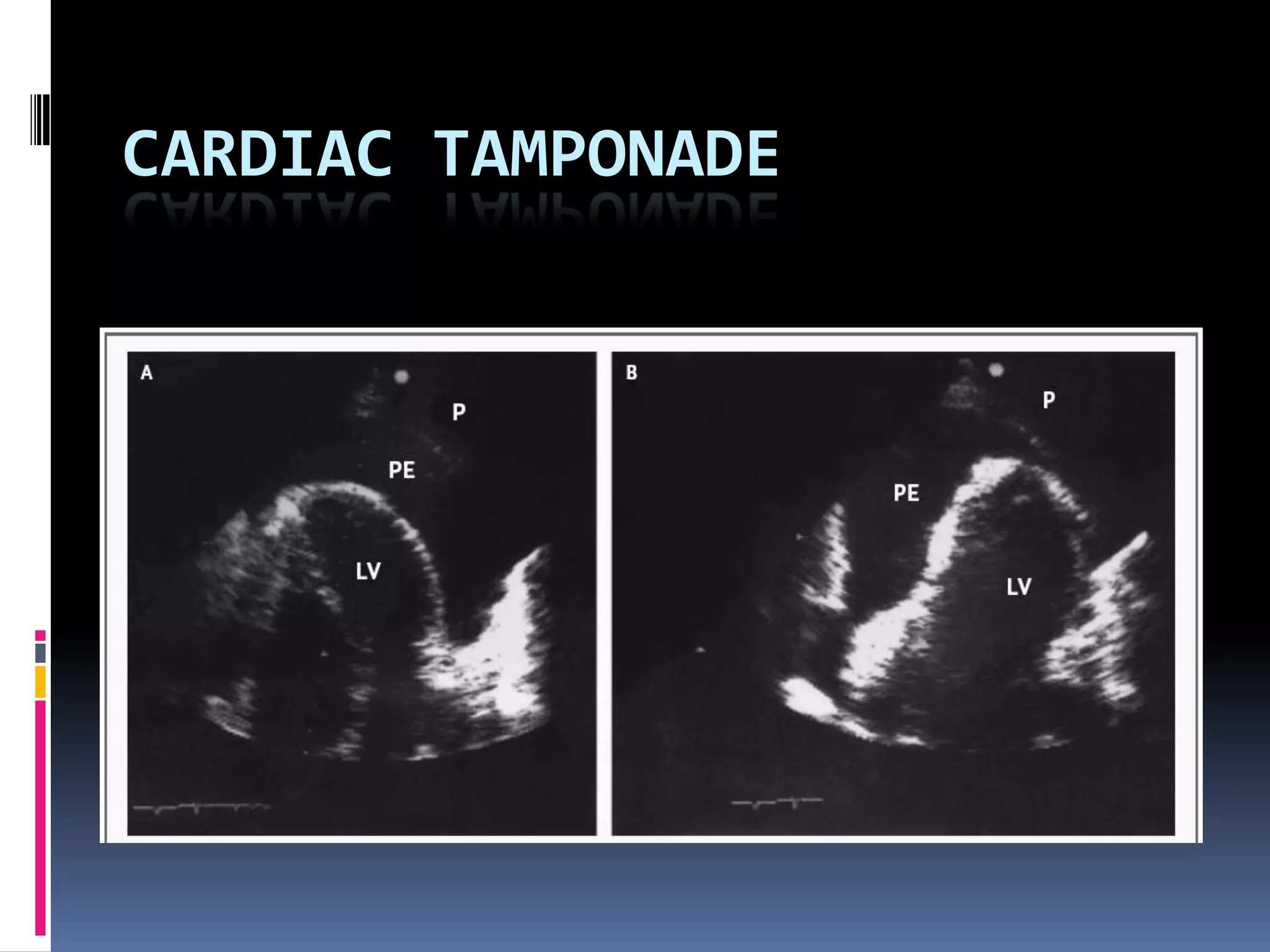 CARDIAC TAMPONADE
 