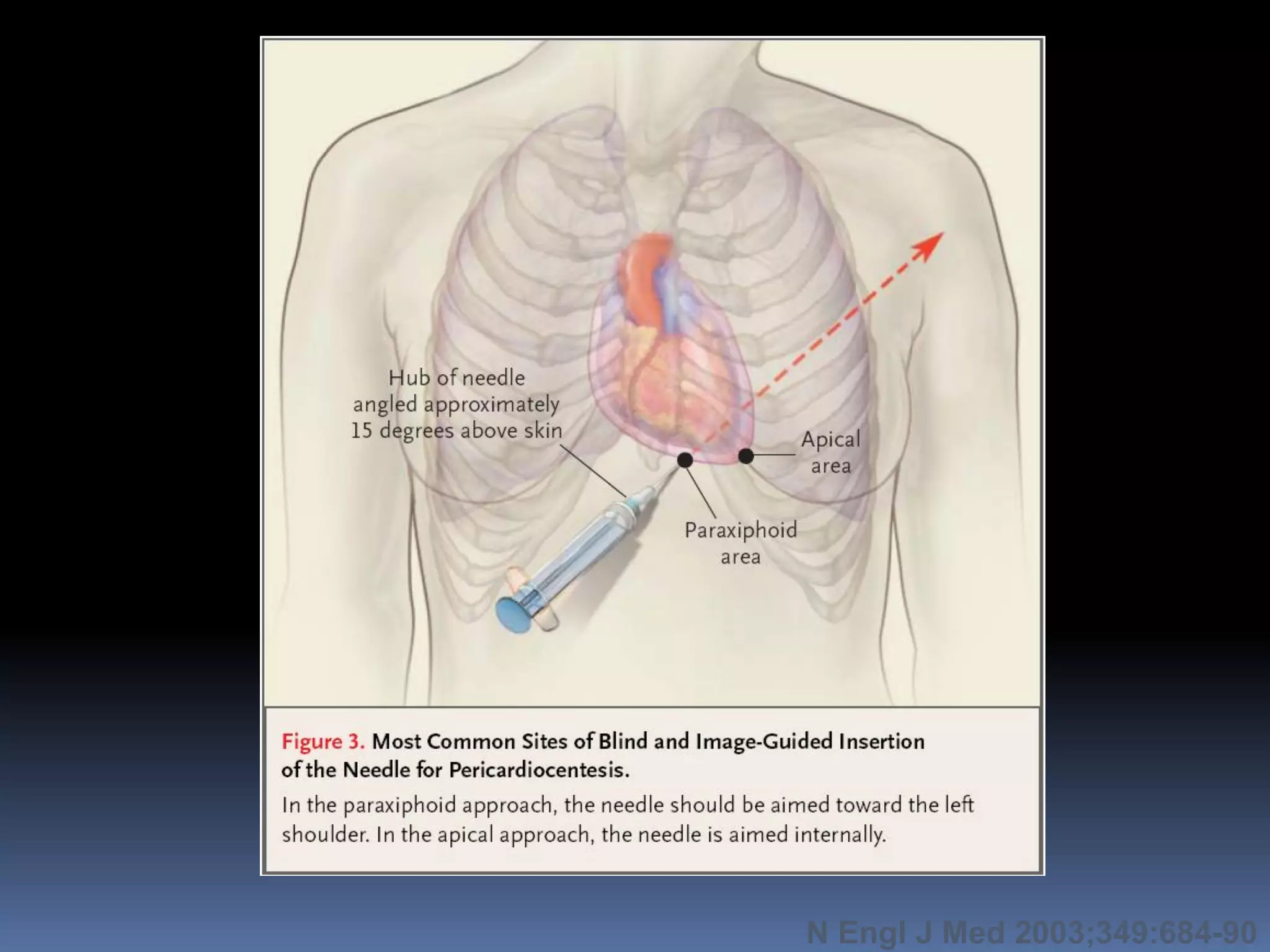 N Engl J Med 2003;349:684-90
 
