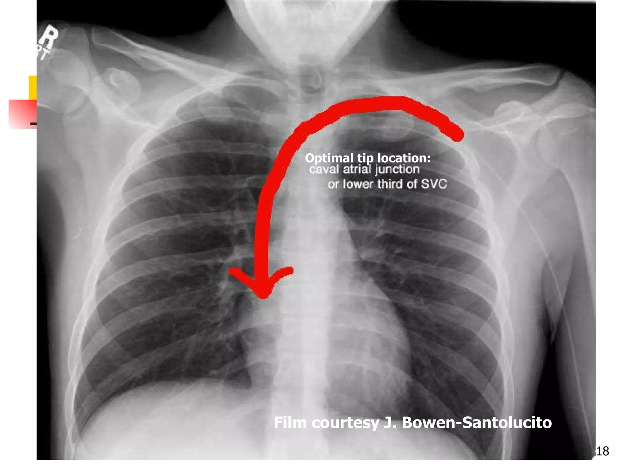 Know your  VAD! vascular access device audio Central: terminates at or near the heart.  Peripheral: short (~1 inch); usually in forearm.  Midline: ~6-8 inches, terminates in upper arm. Where’s the catheter tip? Film courtesy J. Bowen-Santolucito Optimal tip location: 