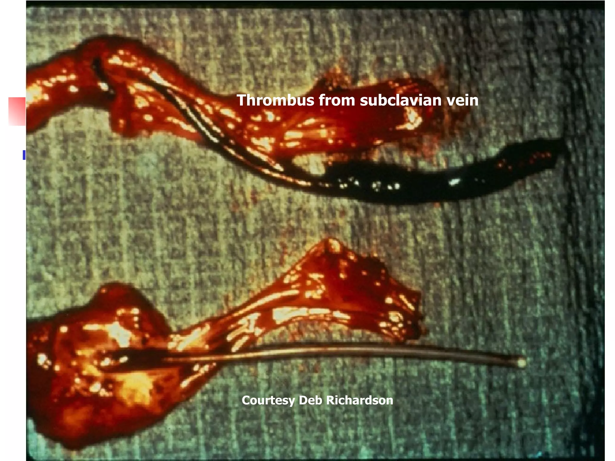 Problem: Emboli audio   Different types of emboli Air  Catheter Wire  Thromboembolus  What is wrong with this picture? No connectors = potential air embolus What is wrong with this picture? Torn catheter = potential catheter embolus  Catheter tip Stylet (wire) Thrombus from subclavian vein Courtesy Deb Richardson 