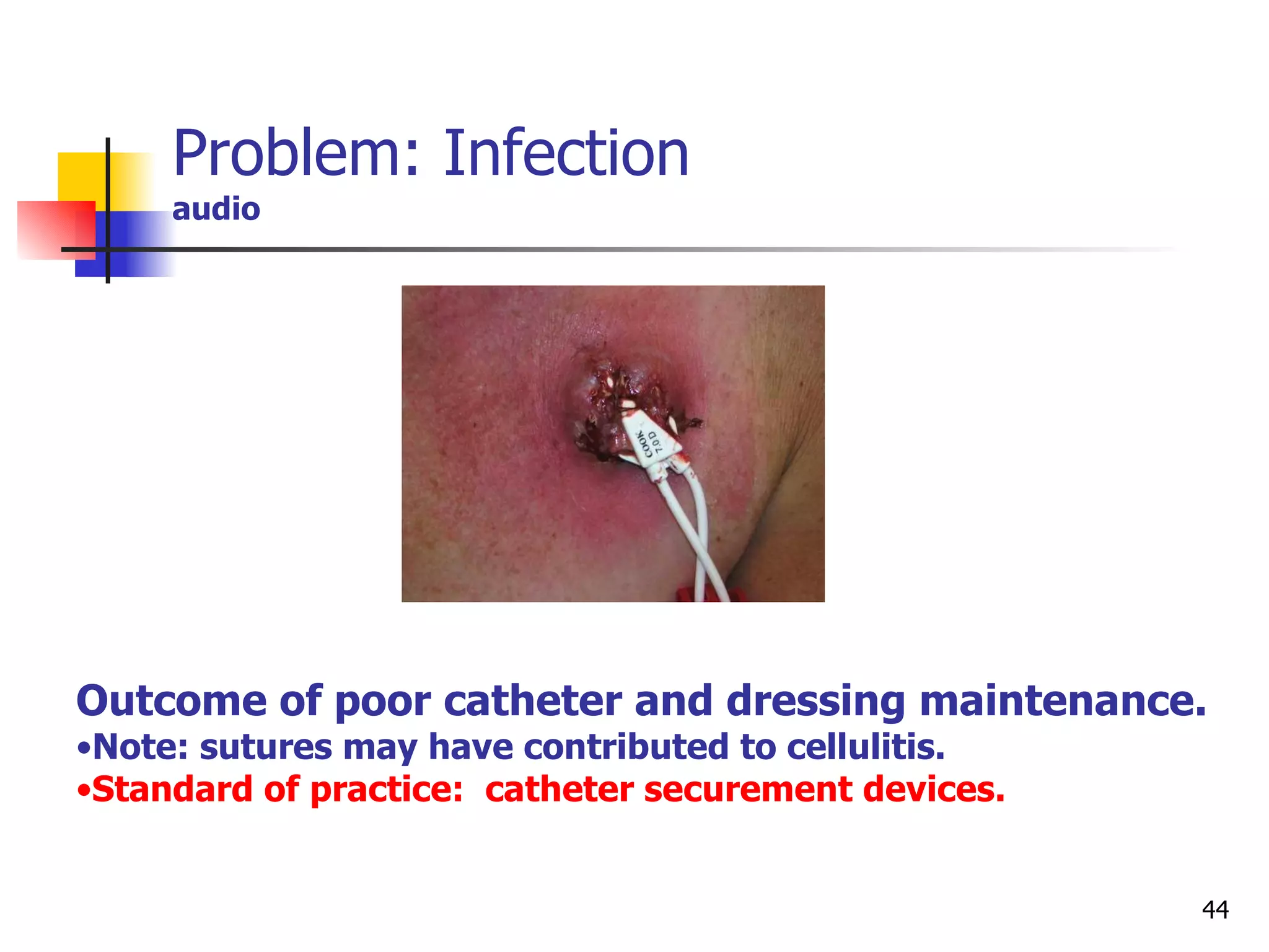 Problem: Infection audio Outcome of poor catheter and dressing maintenance. Note: sutures may have contributed to cellulitis.  Standard of practice:  catheter securement devices. 