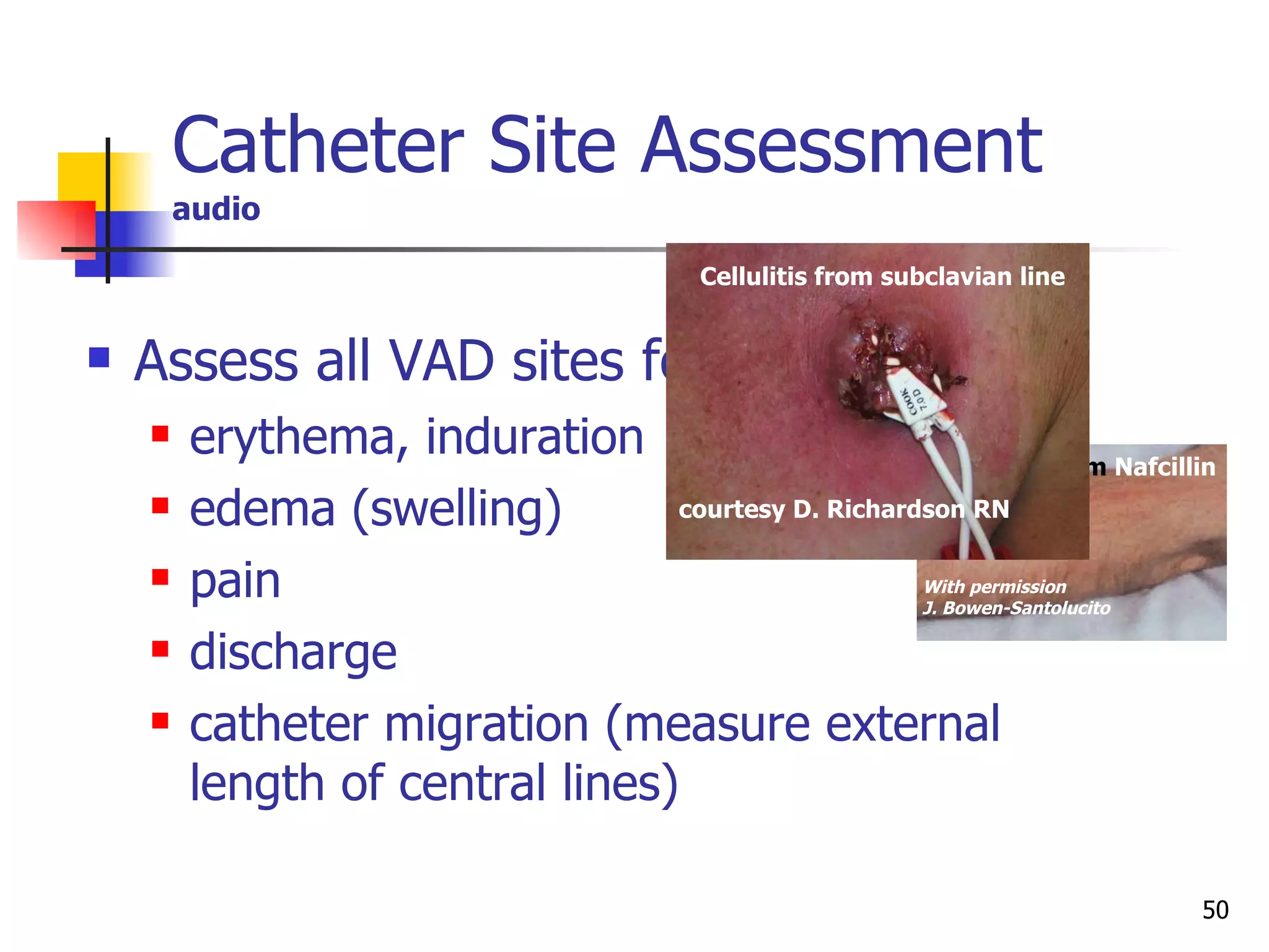 Catheter Site Assessment audio Assess all VAD sites for:  erythema, induration edema (swelling) pain discharge catheter migration (measure external length of central lines) With permission J. Bowen-Santolucito Phlebitis from  Nafcillin courtesy D. Richardson RN Cellulitis from subclavian line 
