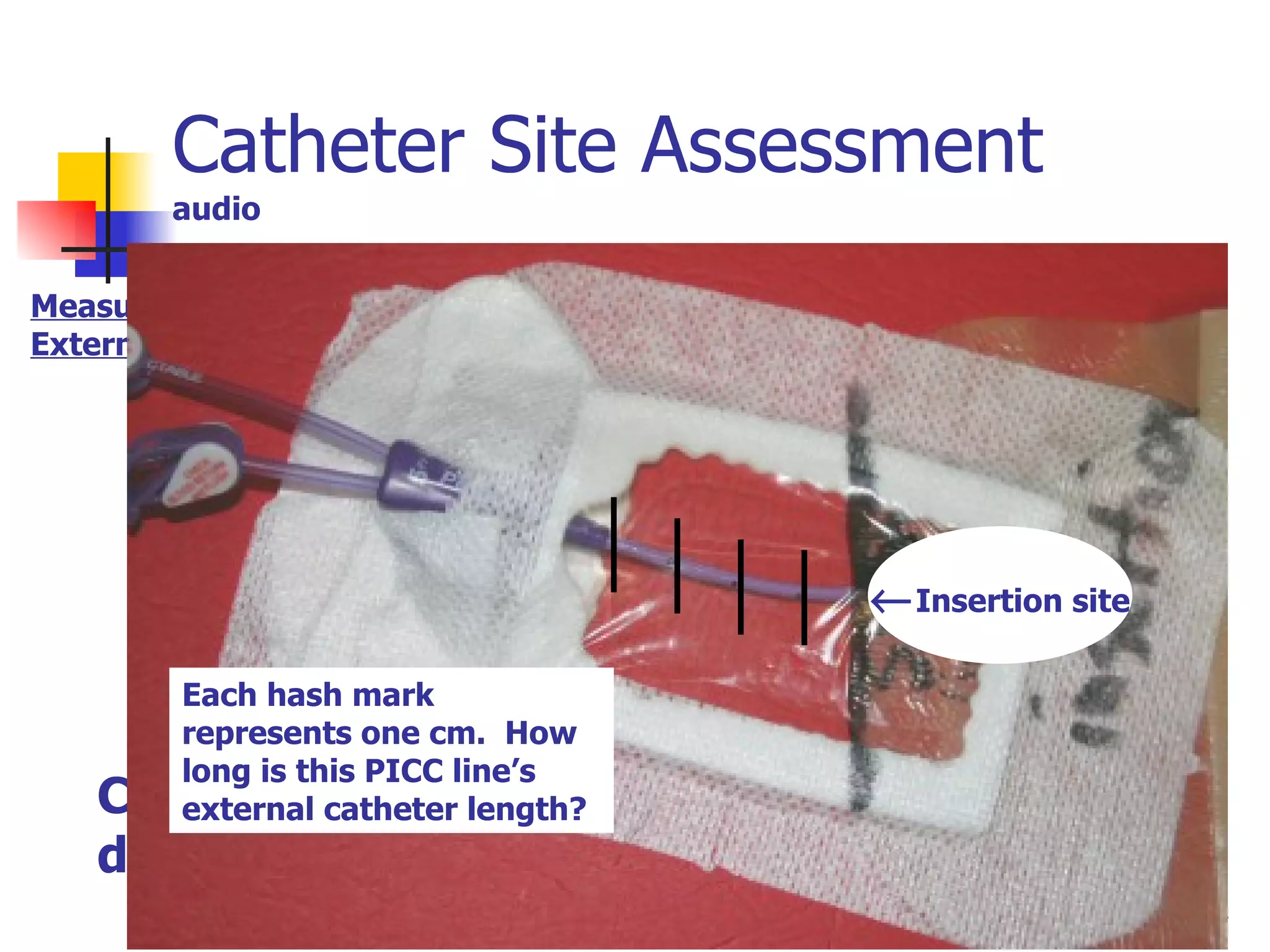 Catheter Site Assessment audio junction Clue:  if any catheter is visible outside of dressing – catheter has likely migrated. Measuring External Catheter Measure to suture wing  junction Leave dressing in place Each hash mark represents one cm.  How long is this PICC line’s external catheter length?  Insertion site 