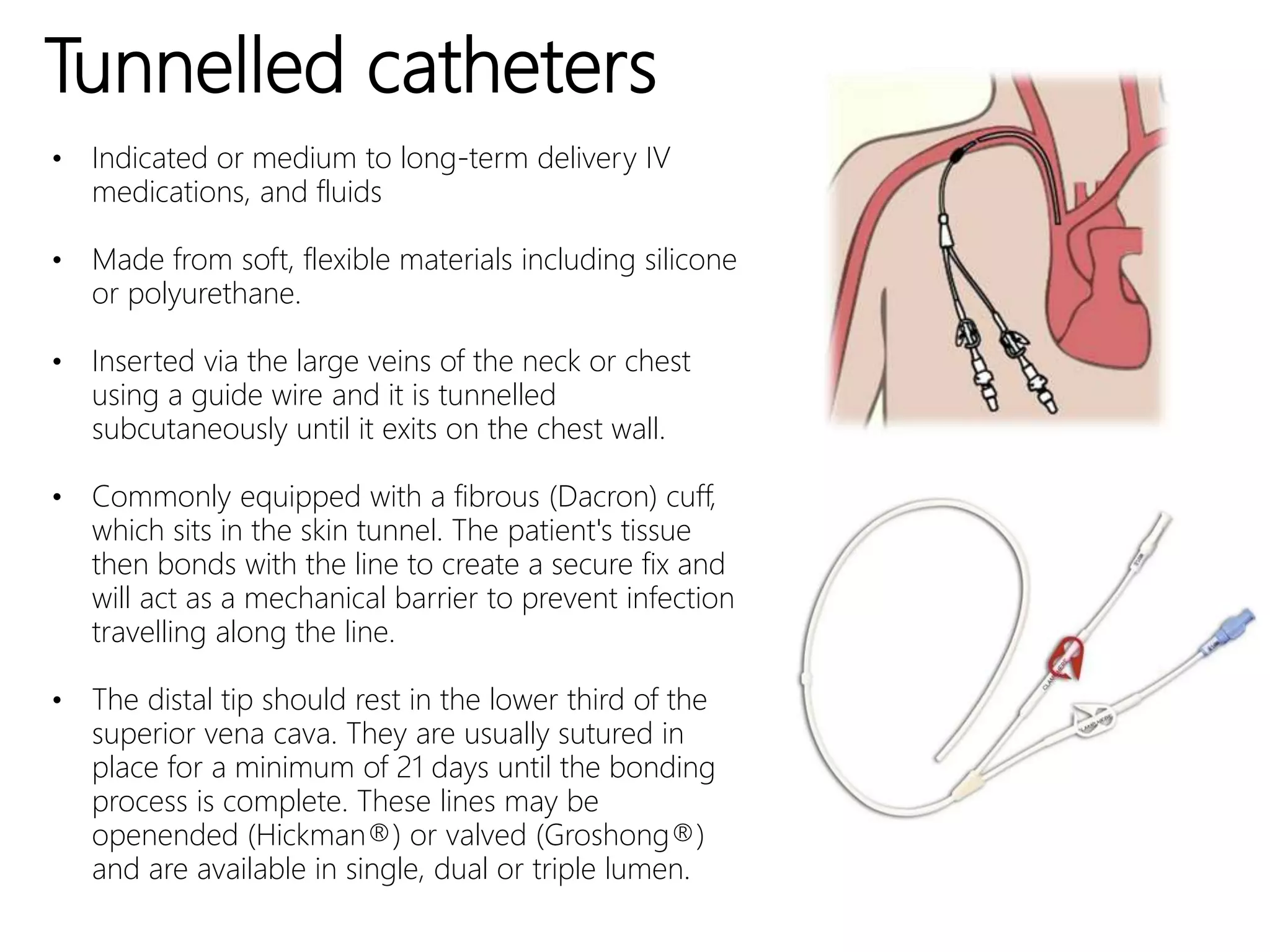 Tunnelled catheters
• Indicated or medium to long-term delivery IV
medications, and fluids
• Made from soft, flexible materials including silicone
or polyurethane.
• Inserted via the large veins of the neck or chest
using a guide wire and it is tunnelled
subcutaneously until it exits on the chest wall.
• Commonly equipped with a fibrous (Dacron) cuff,
which sits in the skin tunnel. The patient's tissue
then bonds with the line to create a secure fix and
will act as a mechanical barrier to prevent infection
travelling along the line.
• The distal tip should rest in the lower third of the
superior vena cava. They are usually sutured in
place for a minimum of 21 days until the bonding
process is complete. These lines may be
openended (Hickman®) or valved (Groshong®)
and are available in single, dual or triple lumen.
 