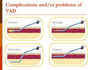 Complications and/or problems of
VAD
Infection Blockage
Dislocation Rupture
 