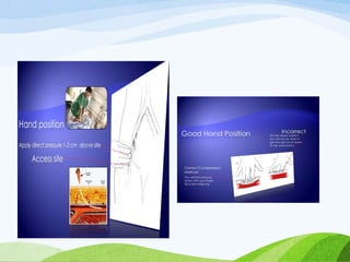 VASCULAR ACCESS,COMPLICATIONS,MERITS
115
 