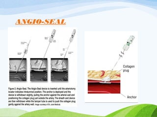 ANGIO-SEAL
 