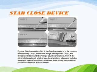 STAR CLOSE DEVICE
 