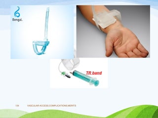 VASCULAR ACCESS,COMPLICATIONS,MERITS
134
TR band
 