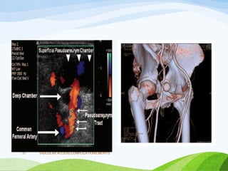 VASCULAR ACCESS,COMPLICATIONS,MERITS
31
 
