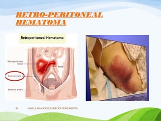 RETRO-PERITONEAL
HEMATOMA
VASCULAR ACCESS,COMPLICATIONS,MERITS
45
 