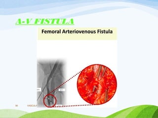 A-V FISTULA
VASCULAR ACCESS,COMPLICATIONS,MERITS
56
 