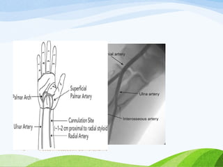 VASCULAR ACCESS,COMPLICATIONS,MERITS
72
 