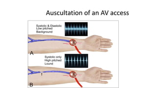 Vascular access in Haemodialysis (2).pptx