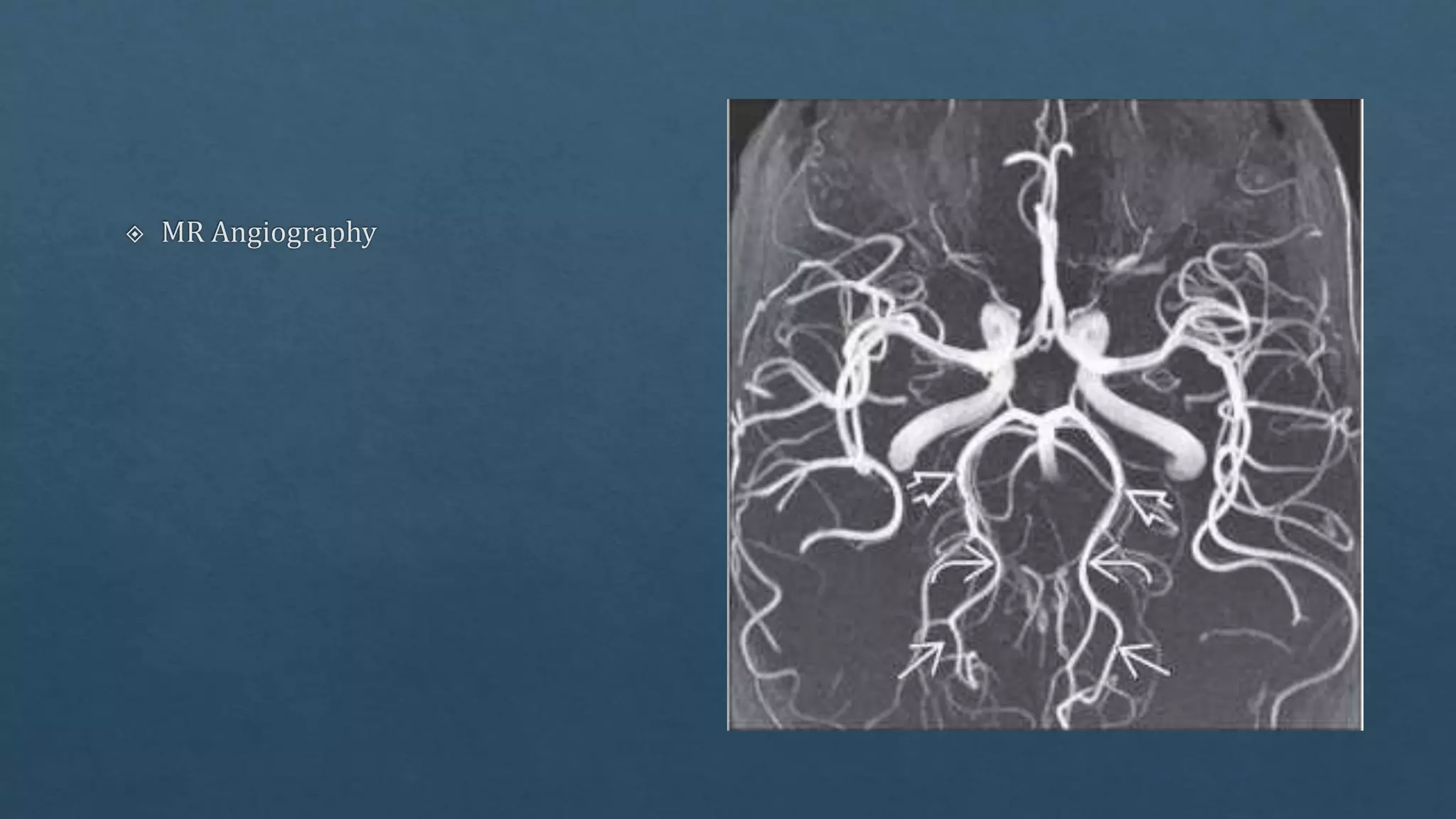 Radiological vascular anatomy of brain | PPTX