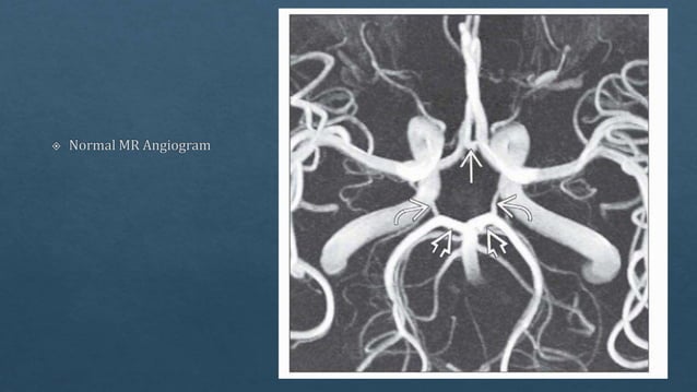 Radiological vascular anatomy of brain | PPTX | Brain and Nervous ...