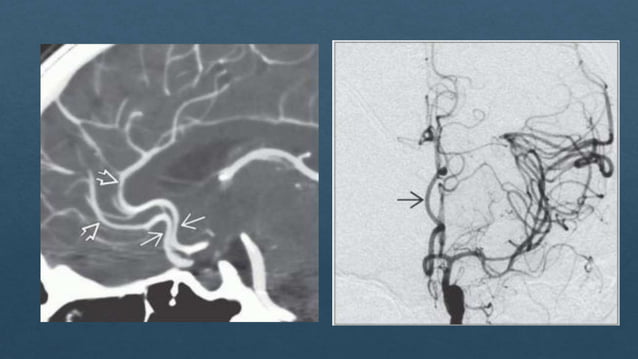 Radiological vascular anatomy of brain | PPTX | Brain and Nervous ...