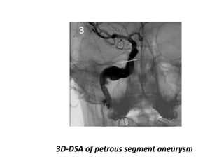 Note the posterior course of the intratympanic
segment ofthe aberrant carotid artery compared with the
normal.
 